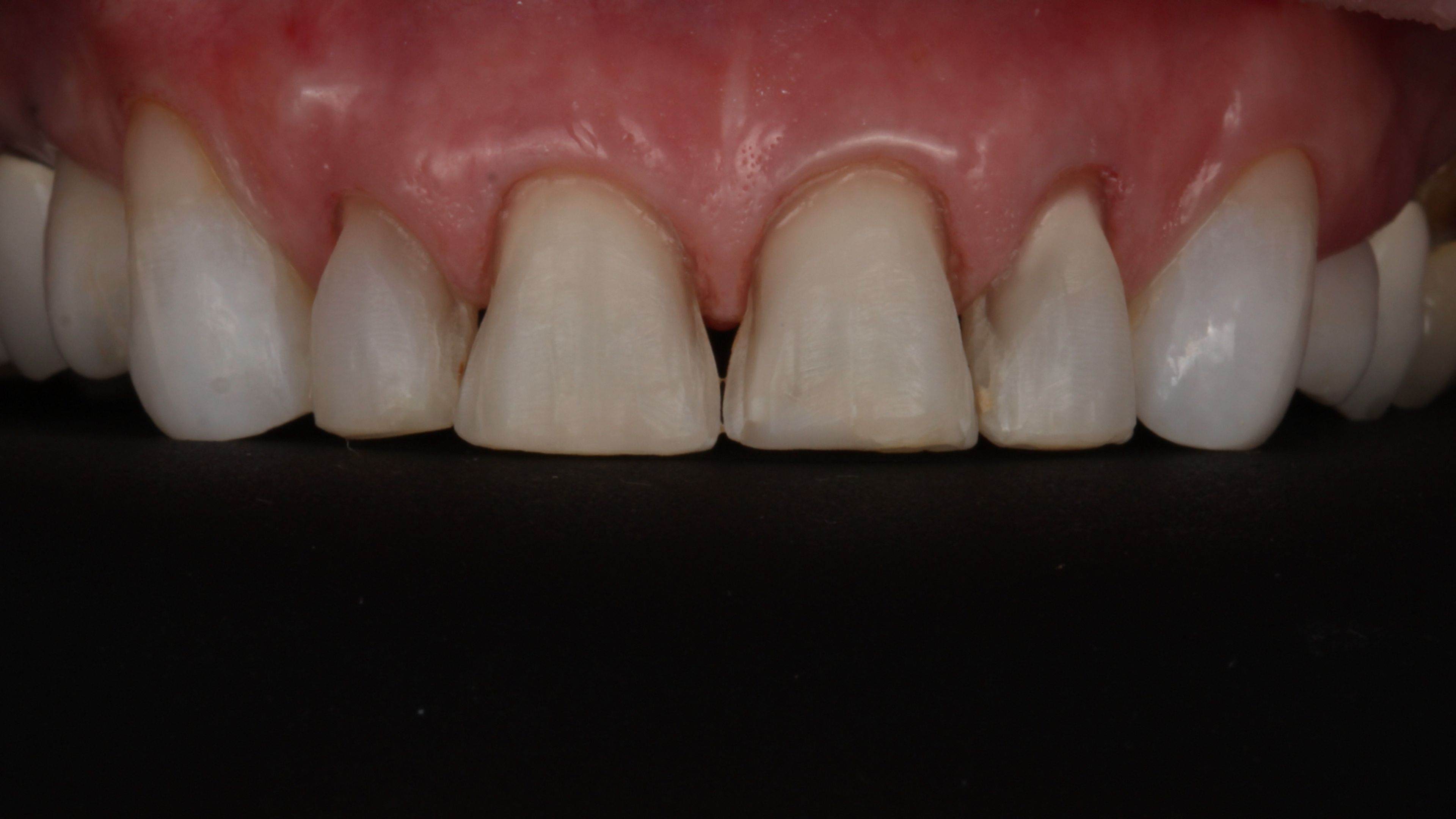 The same teeth after minimal preparation — gentle reshaping that stays entirely within the enamel layer