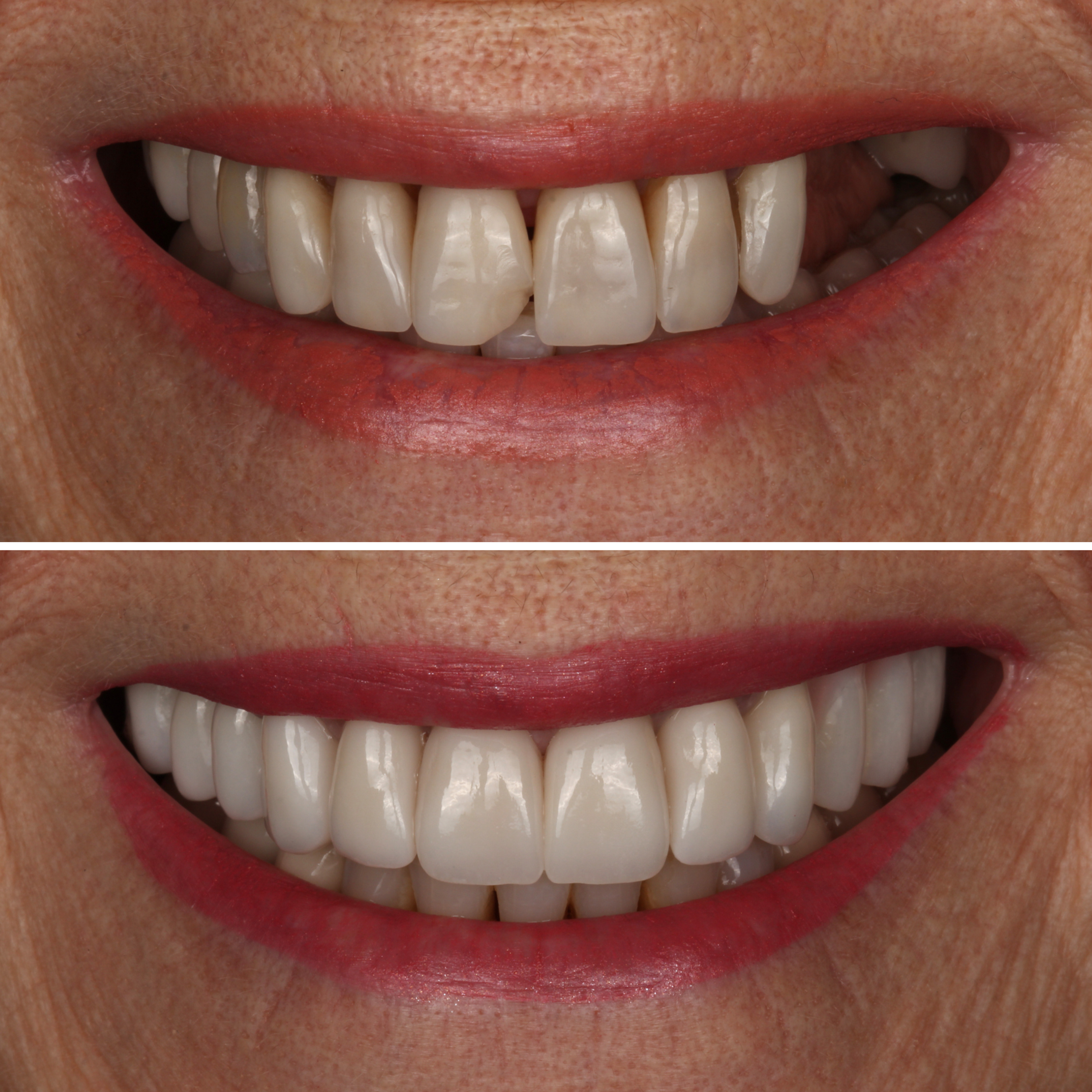 Full Mouth Reconstruction — Rejuvenation before and after - prosthodontist Vancouver - Transcend Dentistry