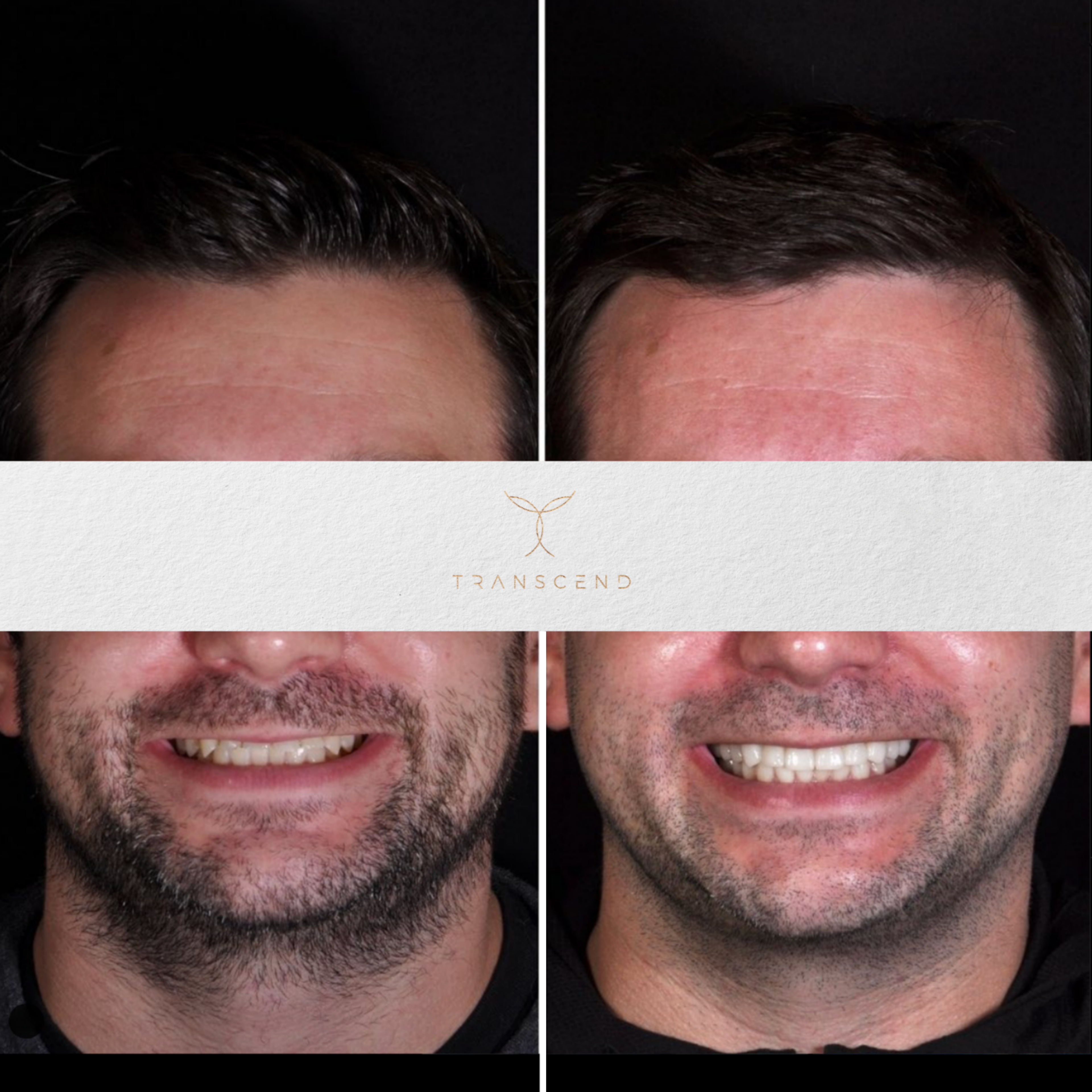 Smile Transformation 1