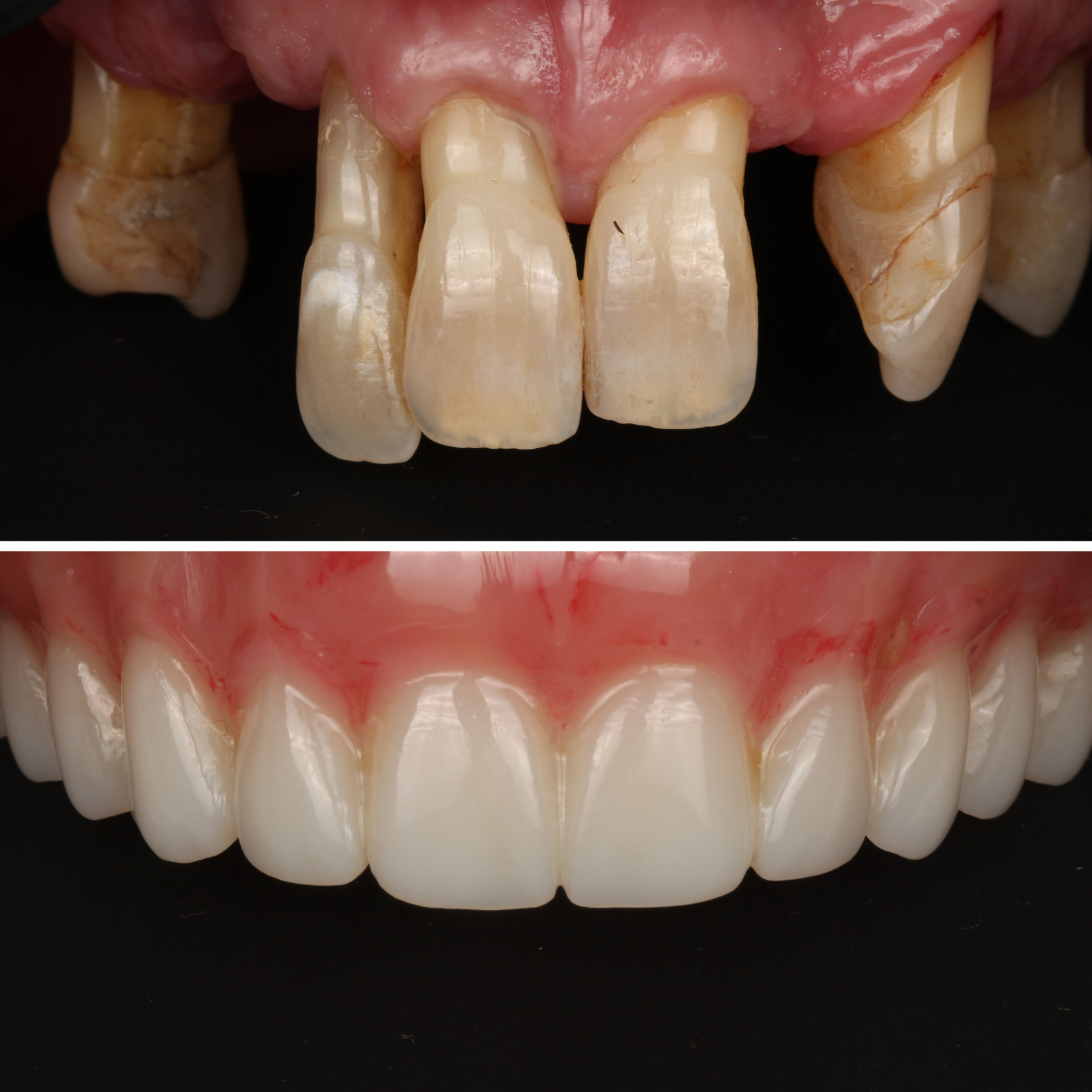 Full arch reconstruction from severe dental damage — before and after