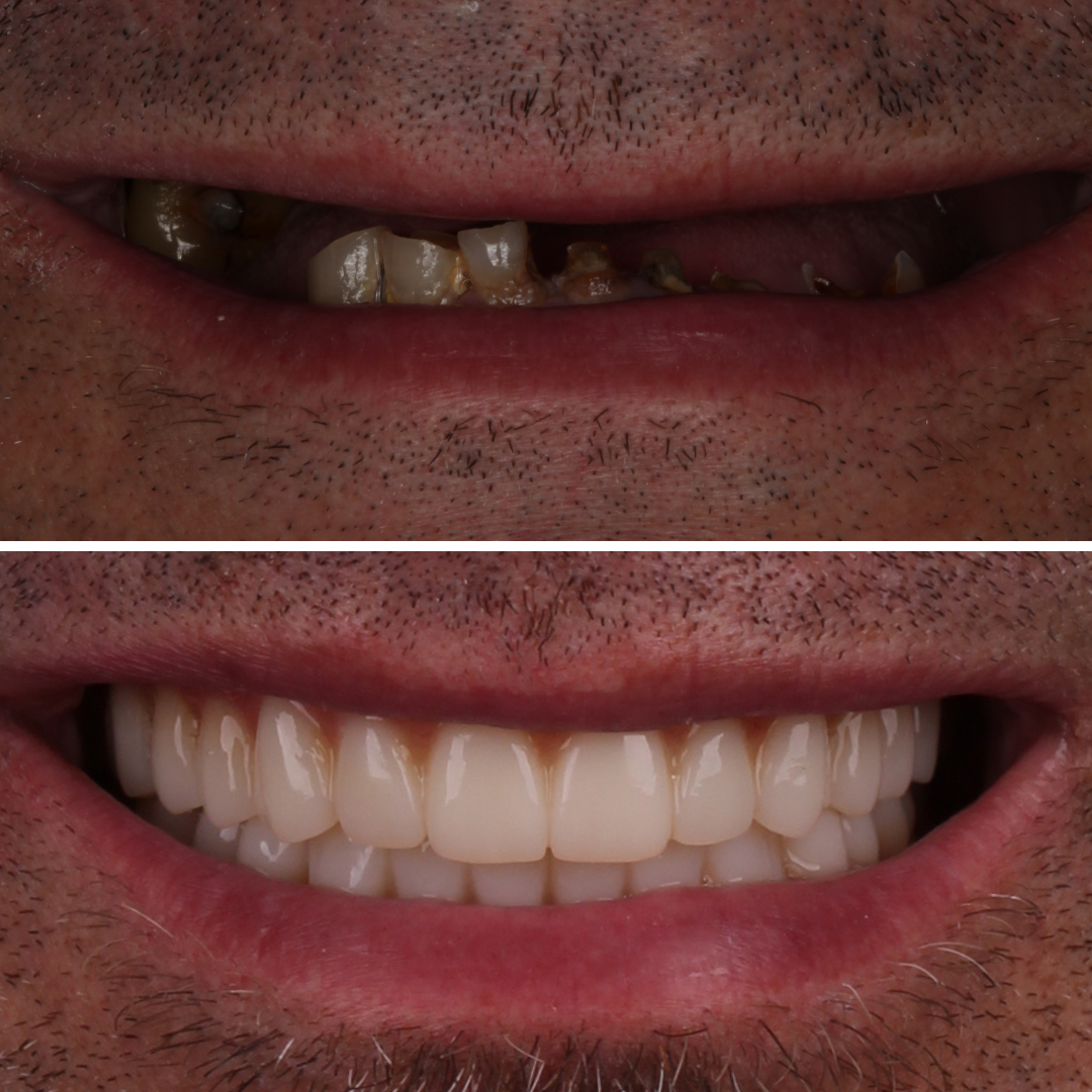 Dentures before and after — specialist dental care at Transcend Dentistry Vancouver