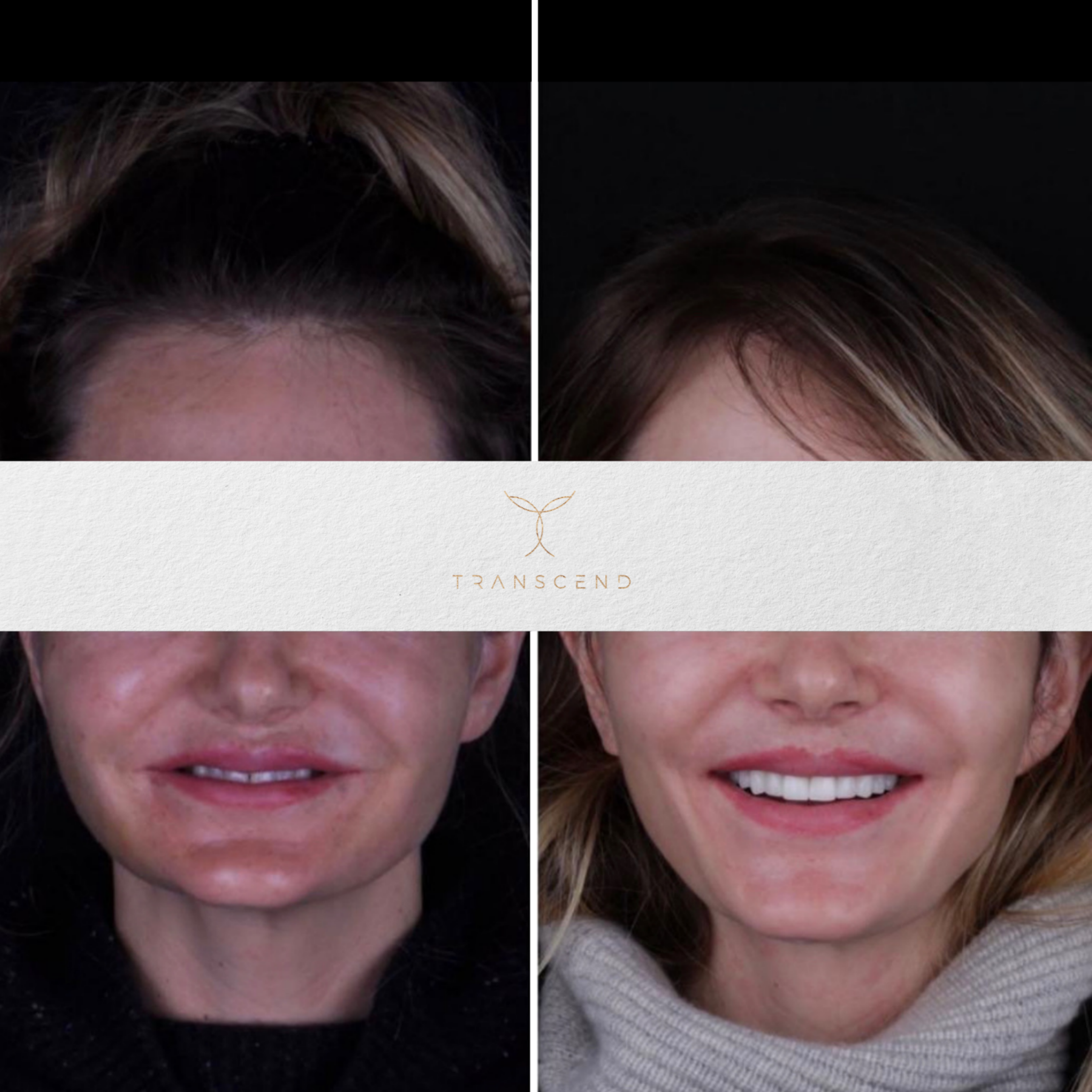 Smile Transformation 2