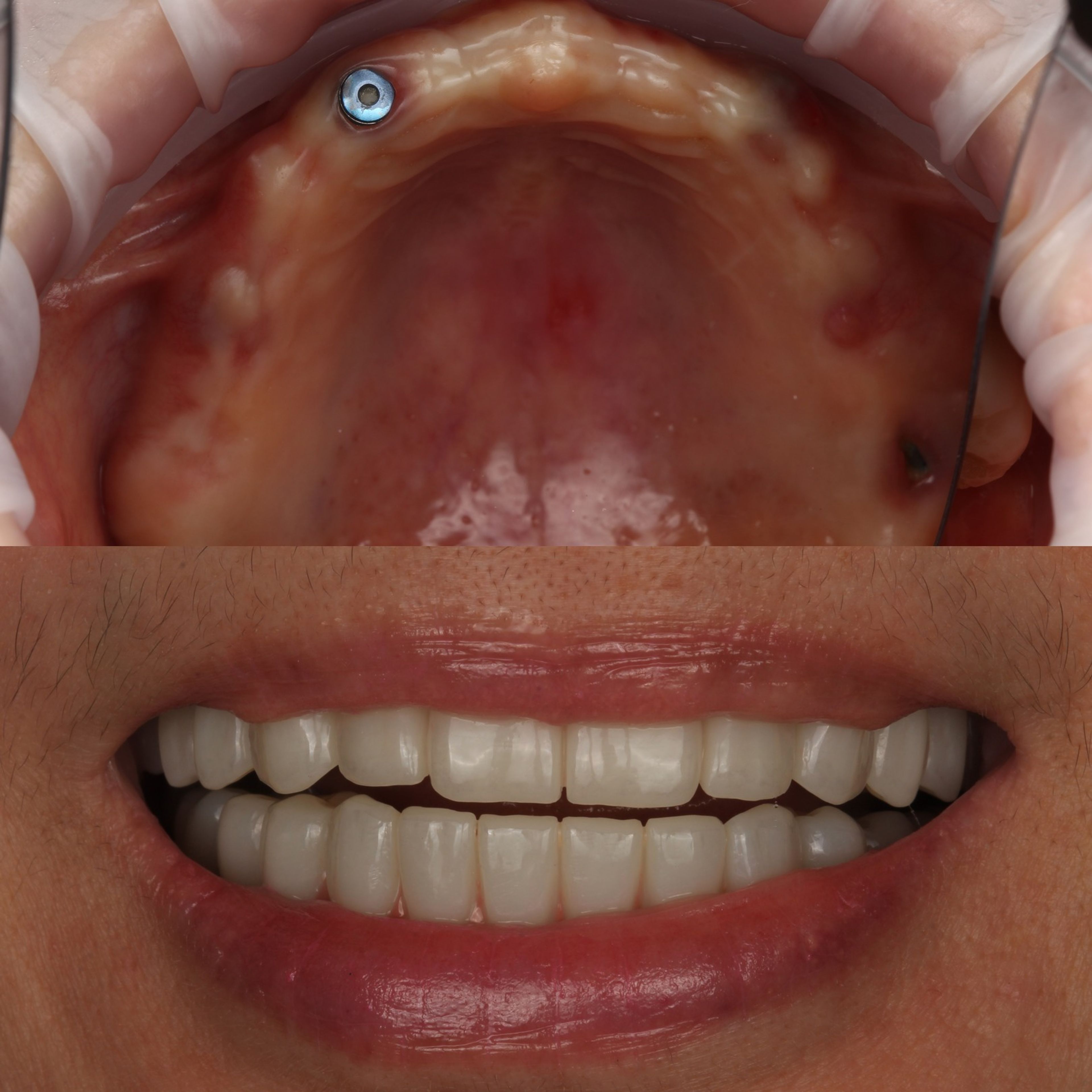 A full-arch redo case at Transcend Specialized Dentistry: above, the upper arch as it arrived from treatment abroad with an implant exposed in a poor position; below, the patient's final smile after the arch was rebuilt