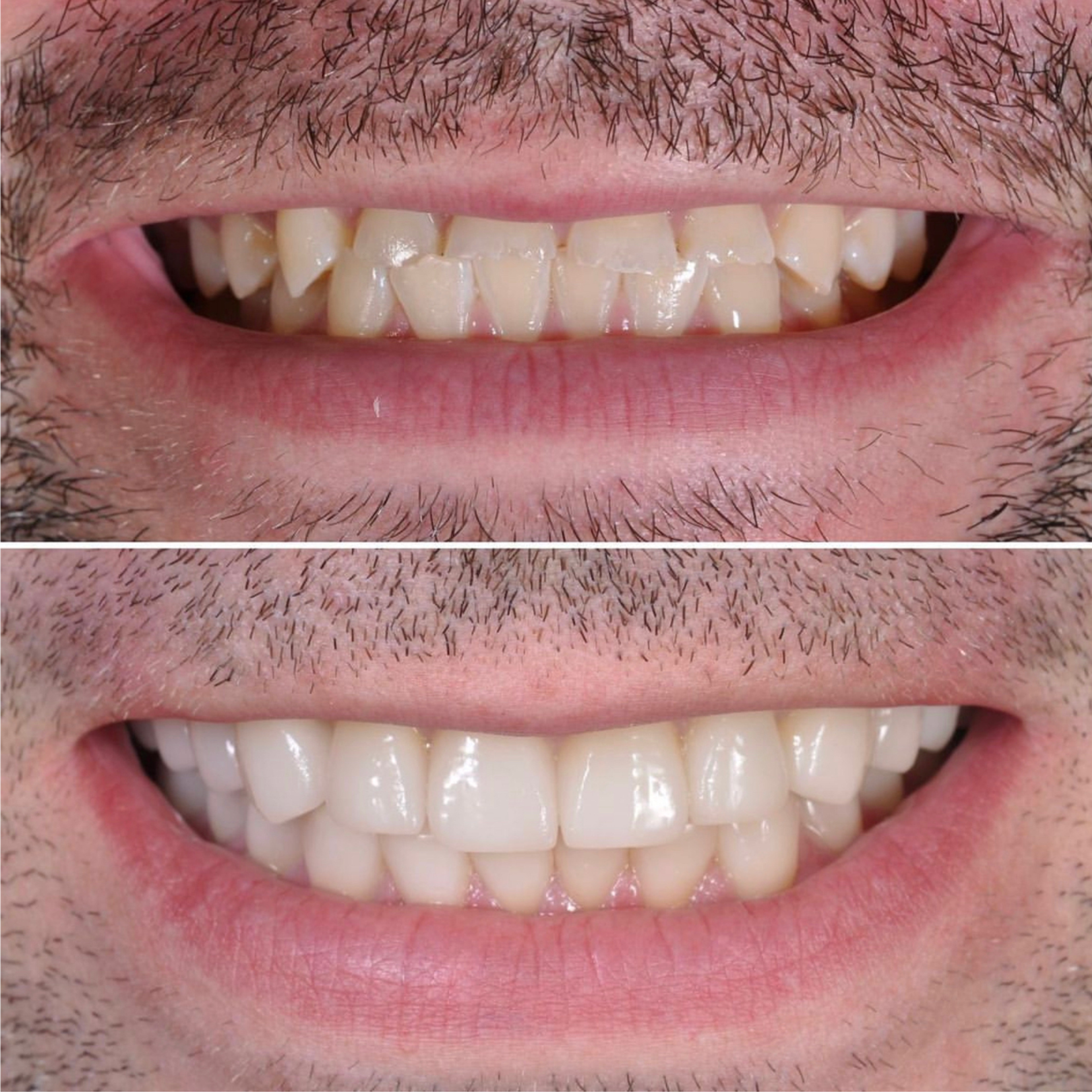 Full Mouth Reconstruction — before and after