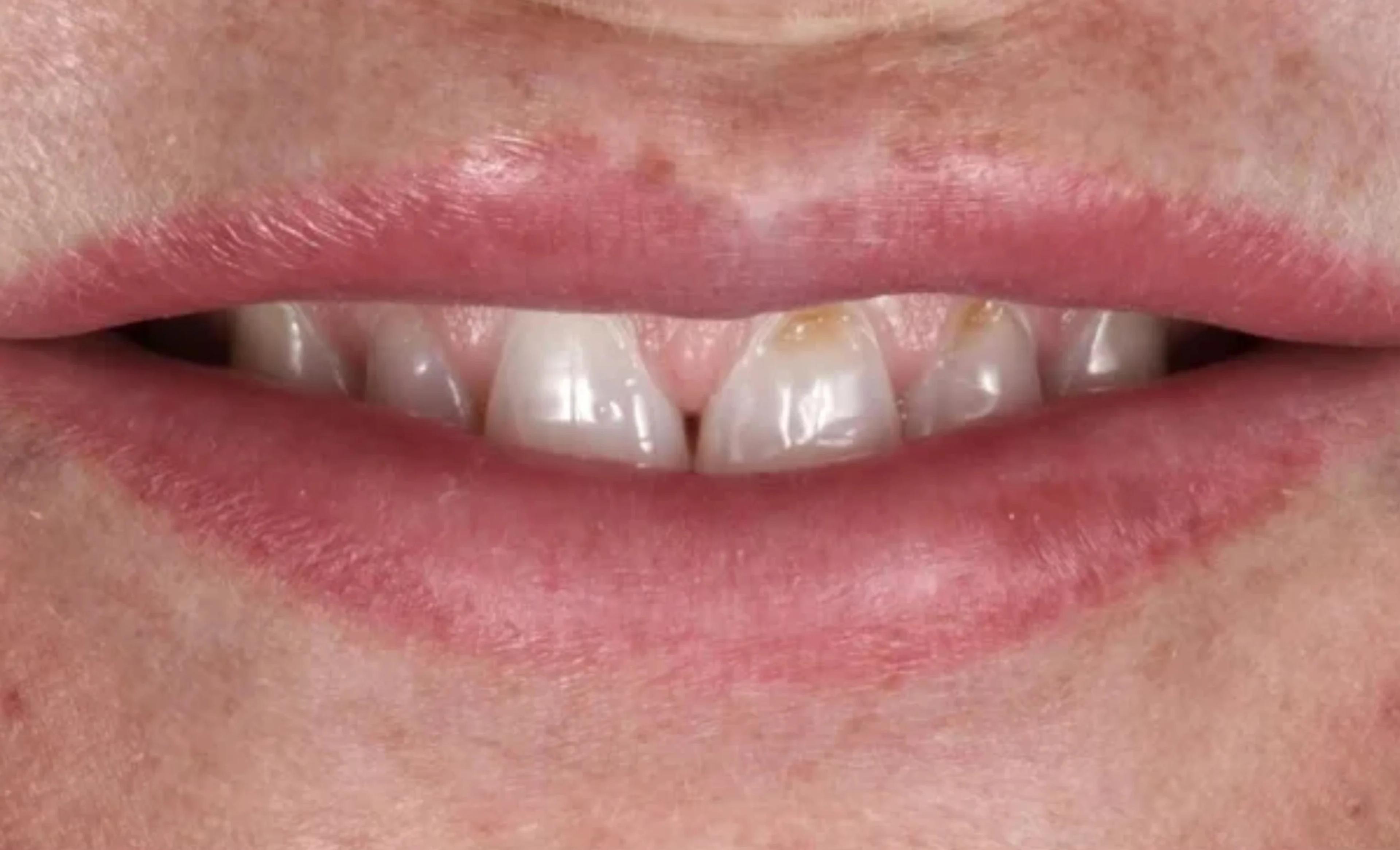 Close-up of a mouth with slightly discolored and spaced-out teeth, "before" picture of veneers.