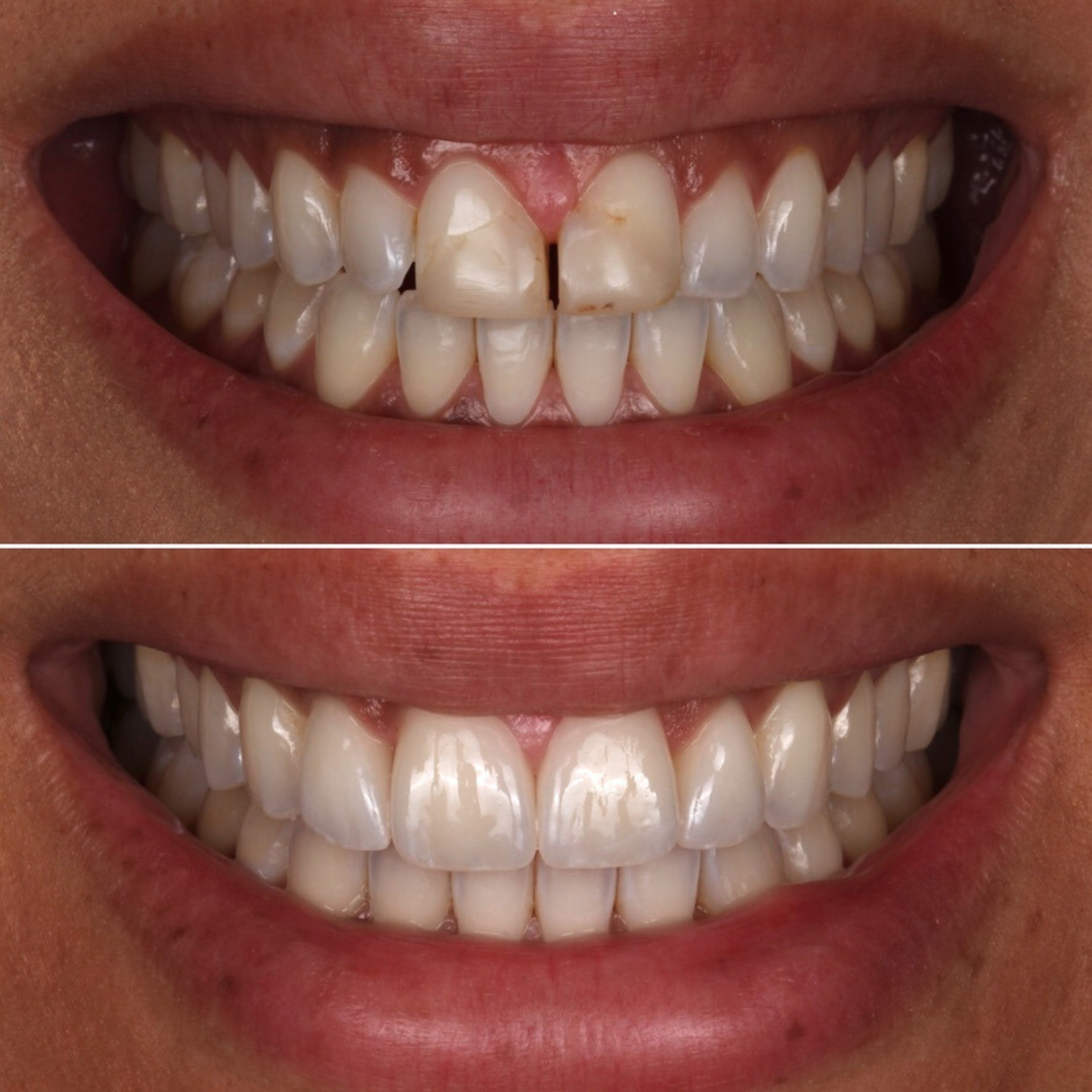 4 Veneers — Full Smile — before and after