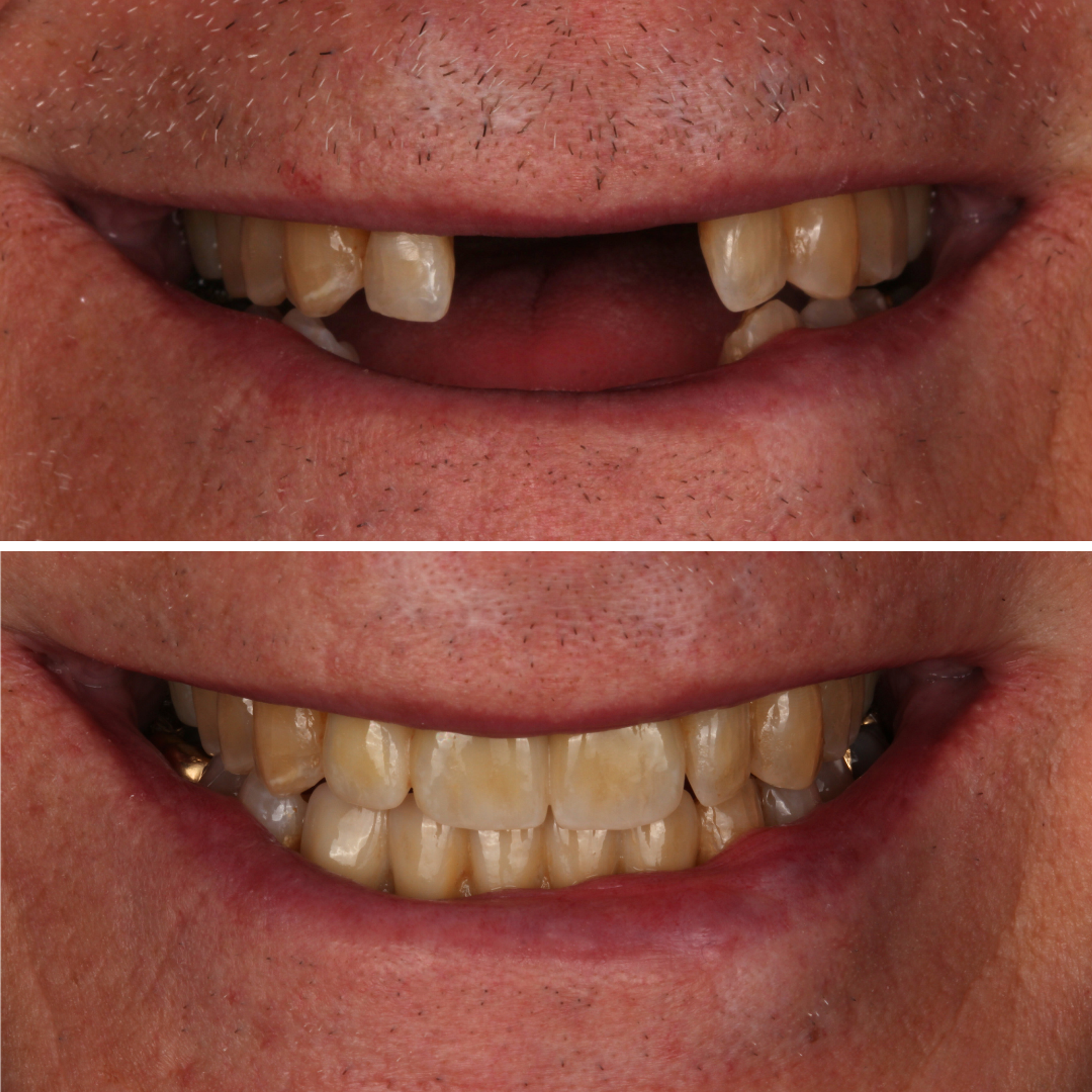 Multiple Anterior Implants before and after - dental implants Vancouver - Transcend Dentistry