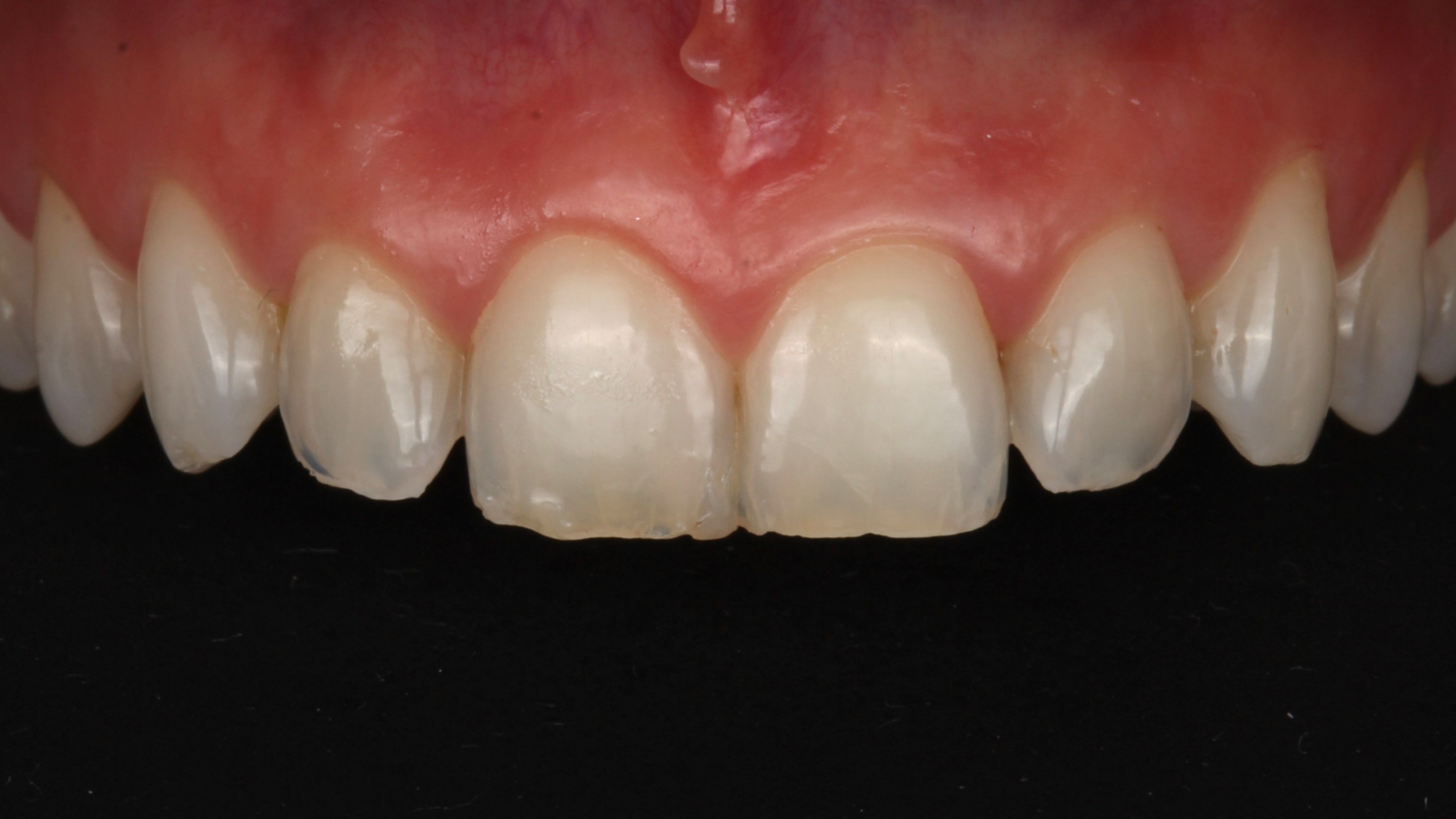 Close-up of worn front teeth before treatment — short, with translucent edges and transparent enamel from years of wear, a textbook no-prep candidate