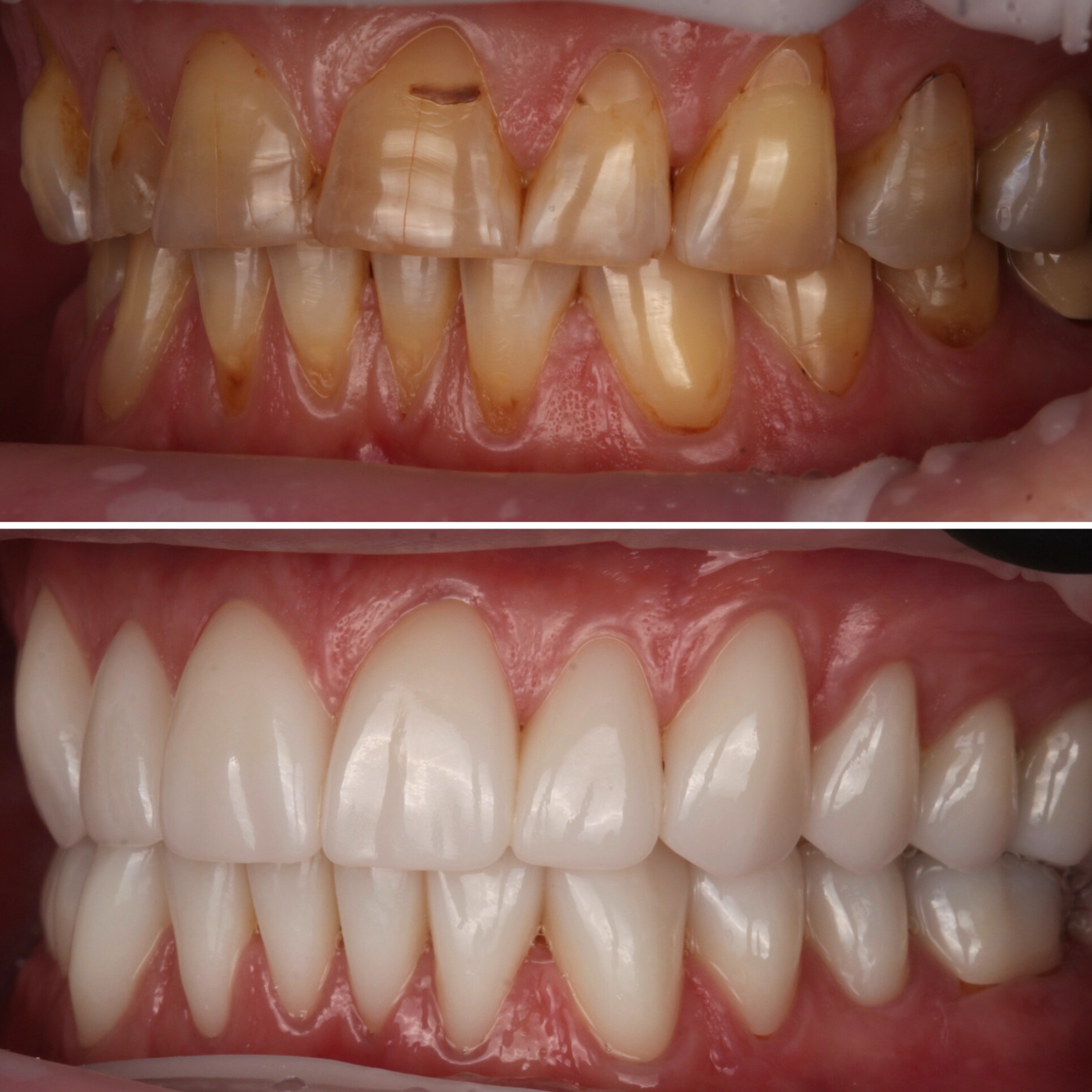 Full Mouth Reconstruction before and after — specialist dental care at Transcend Dentistry Vancouver
