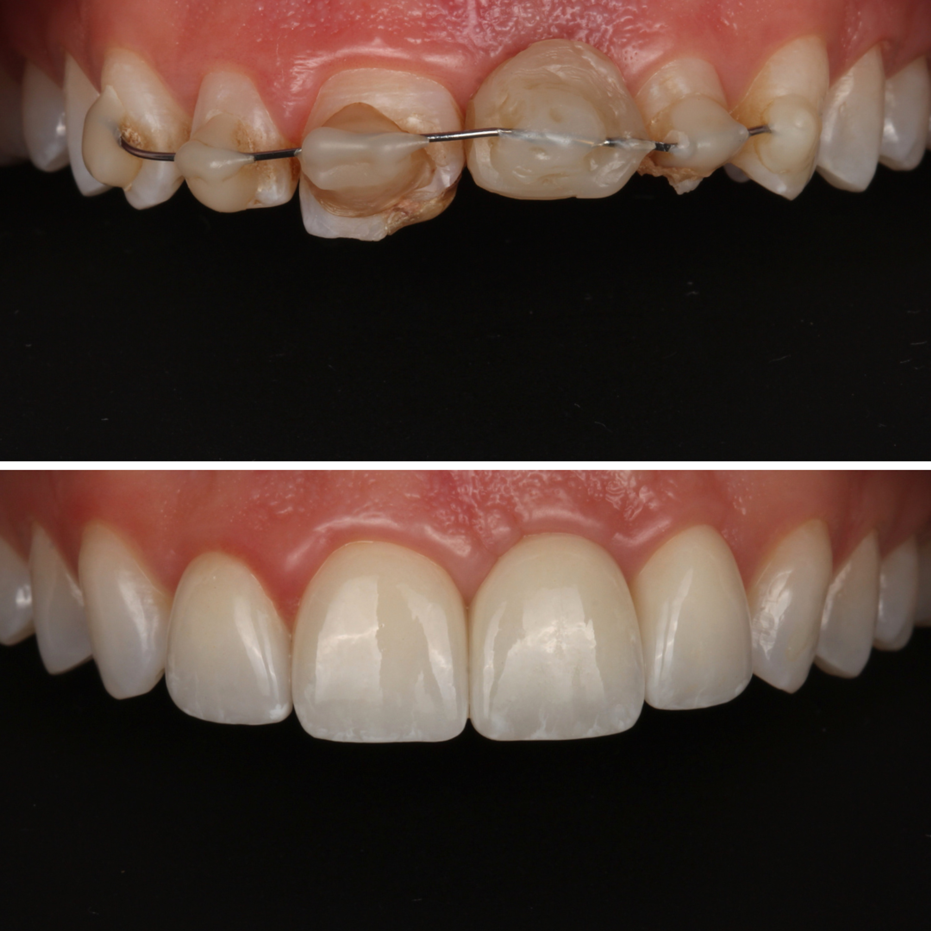 Anterior Teeth Restoration — before and after