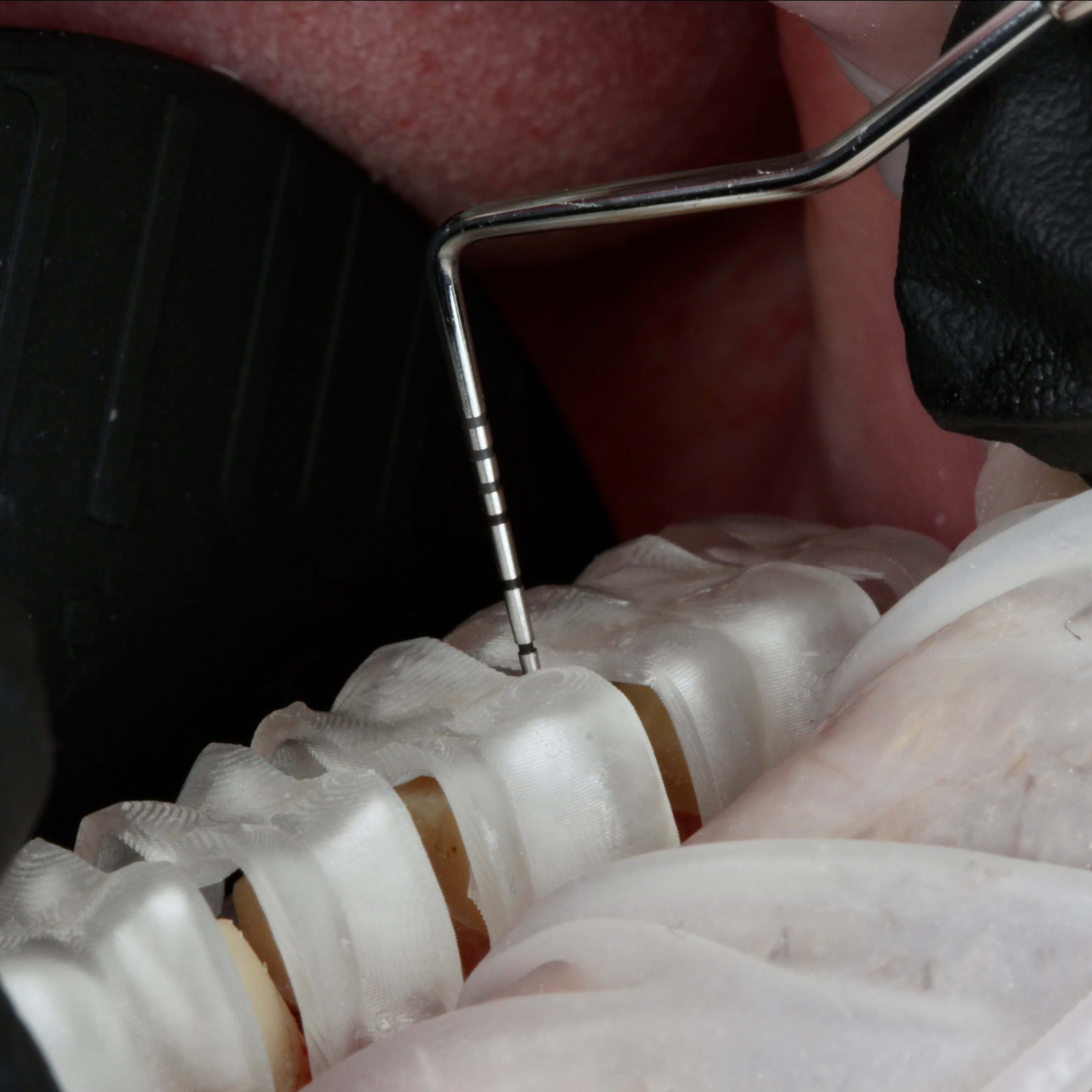 Closeup of a mouth with a drill on teeth oriented using a computer-design guide to ensure accuracy.