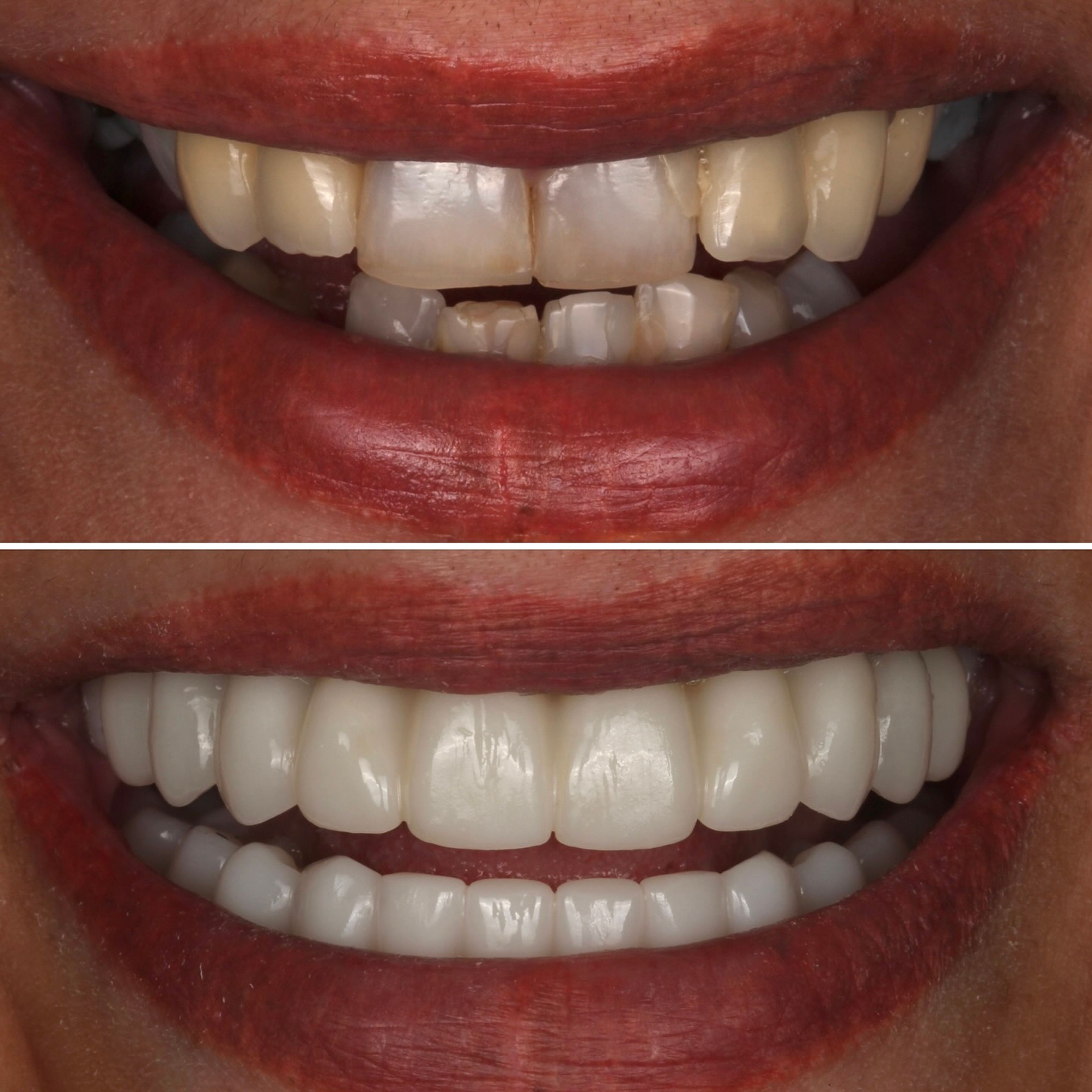 Full Arch Implants before and after - All-on-4 implants Vancouver - Transcend Dentistry