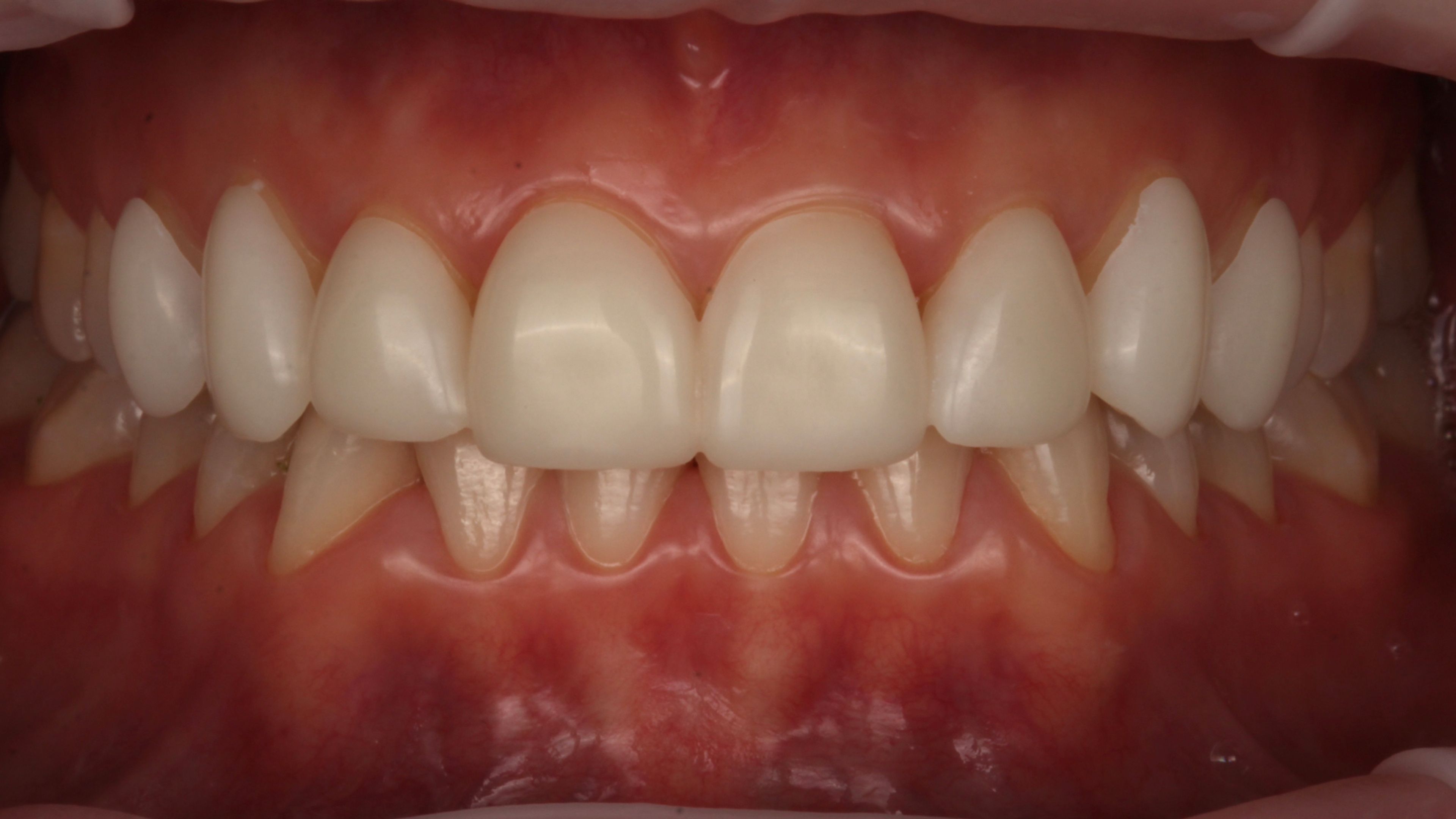 Mock-up: provisional veneers placed on the teeth to preview the planned shape, length, and proportions before final fabrication