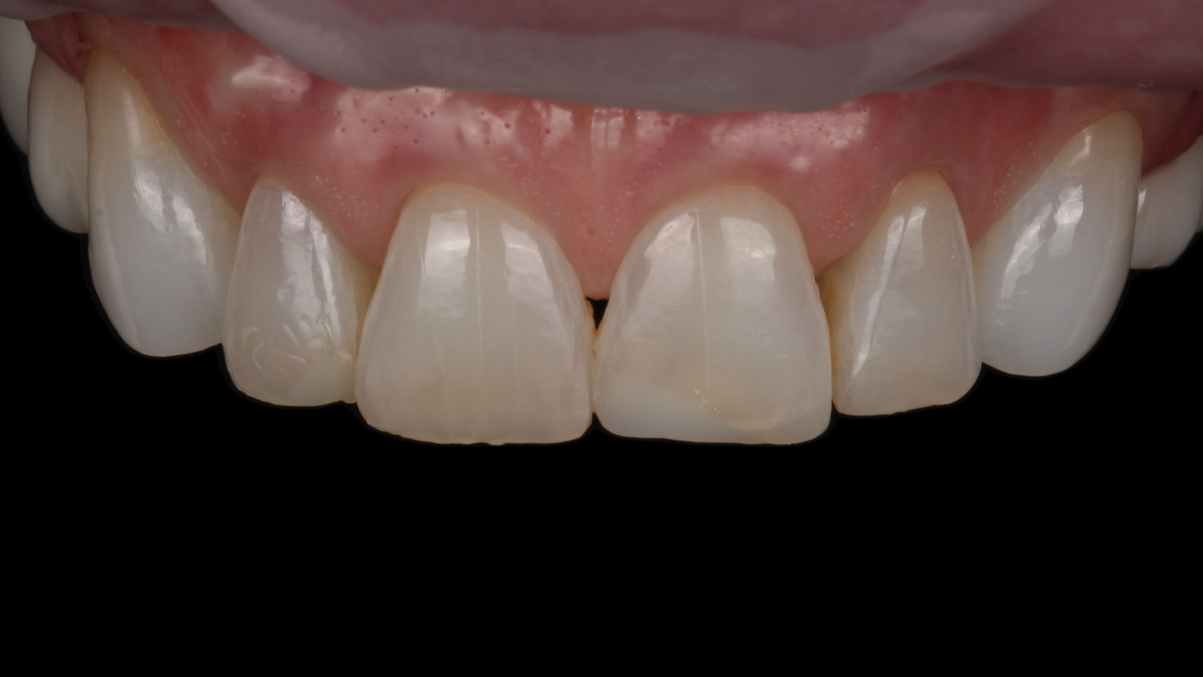 Front teeth before treatment — small spaces and uneven proportions, a candidate for minimal-prep porcelain veneers