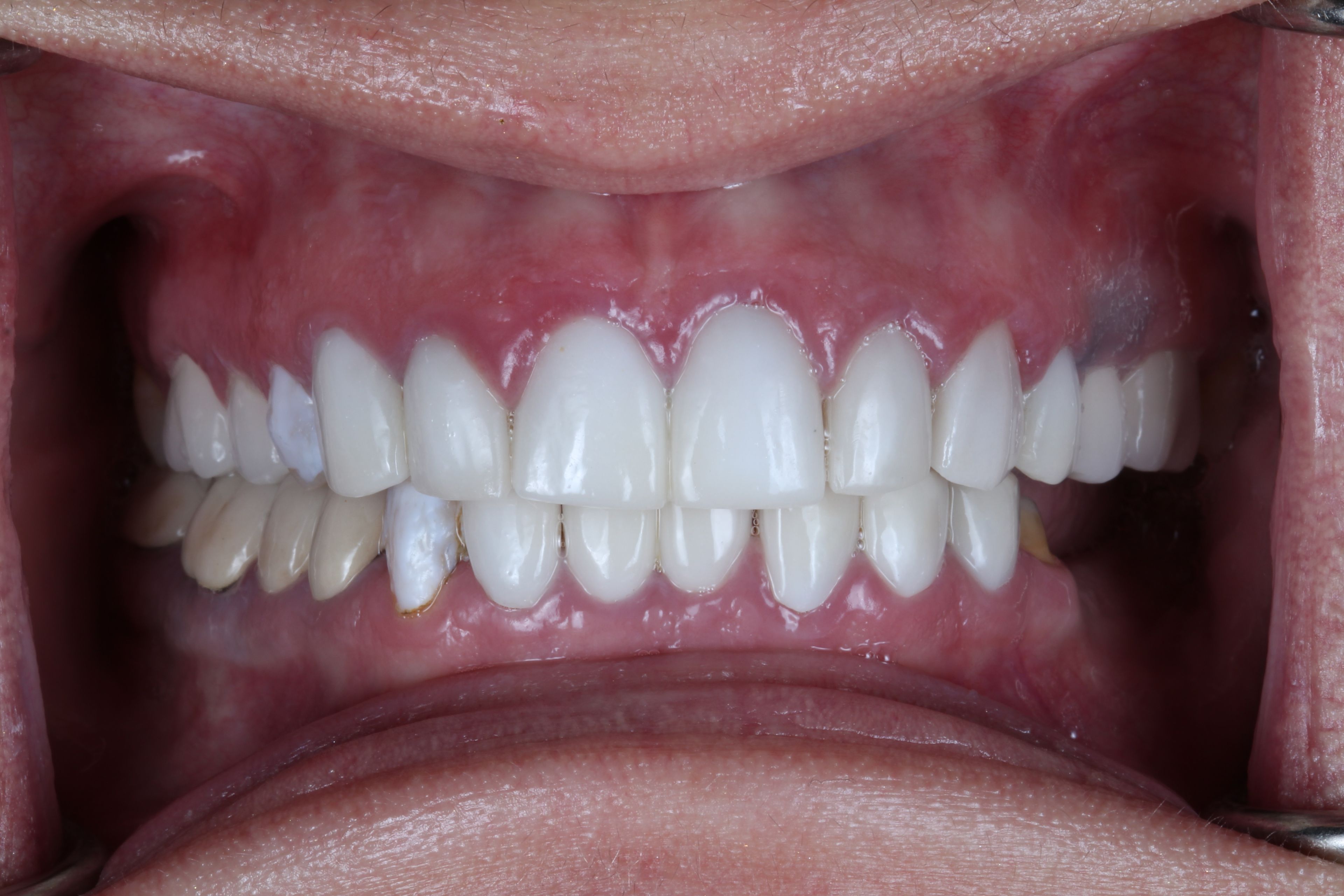 Veneers placed abroad, as they arrived at Transcend — inflamed gum margins around ill-fitting veneers, with one veneer already debonded exposing the prepared tooth underneath