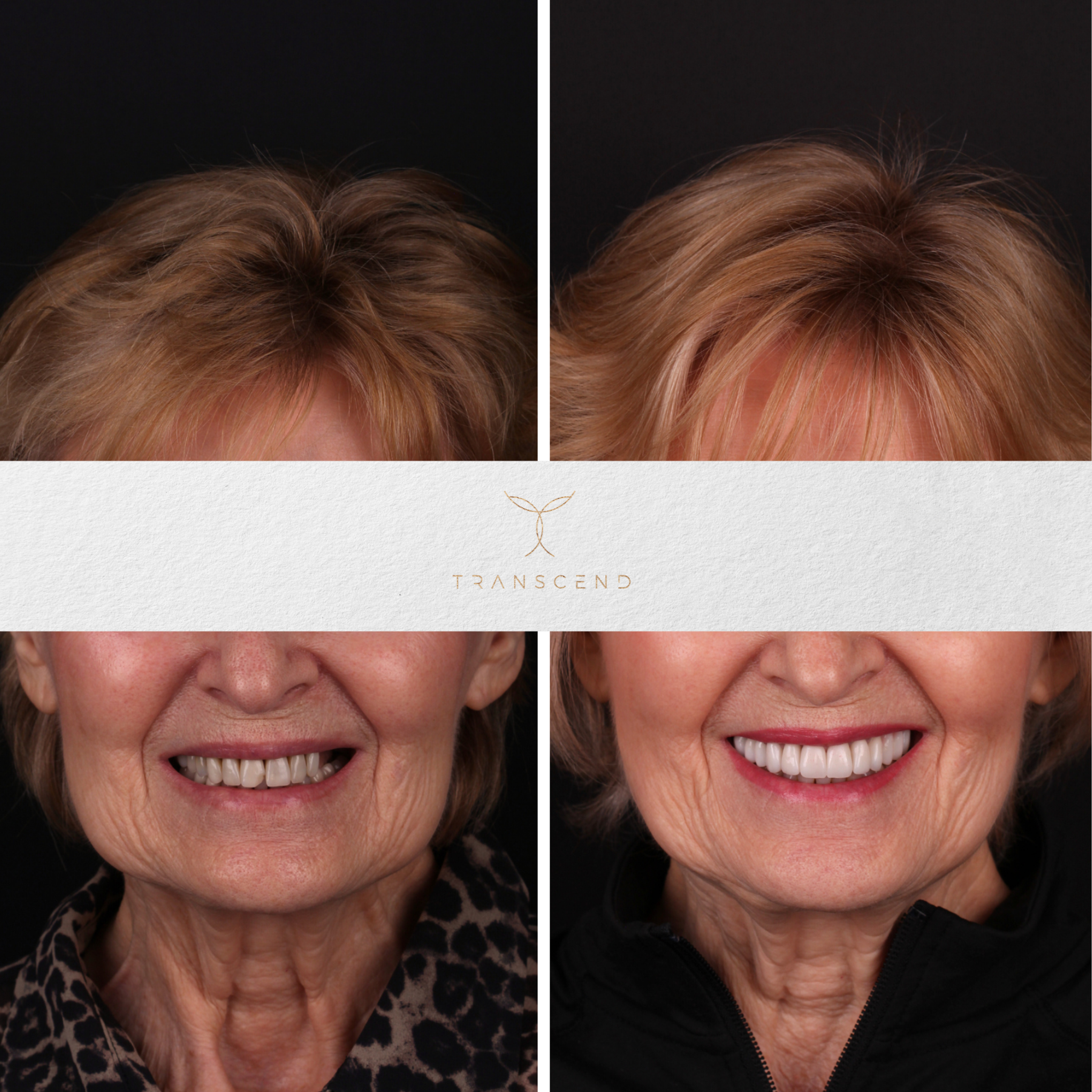 Smile Transformation 4