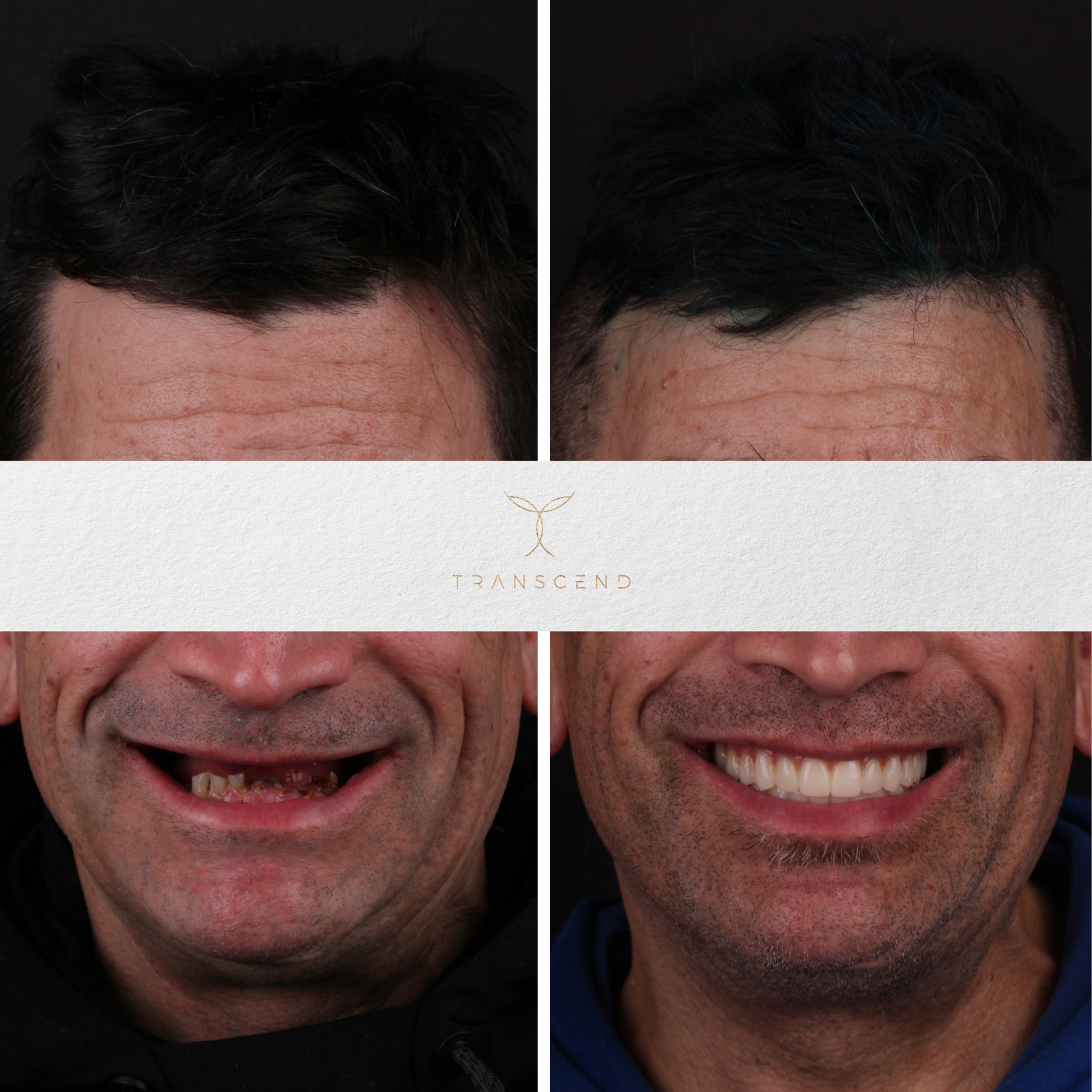 Smile Transformation 3