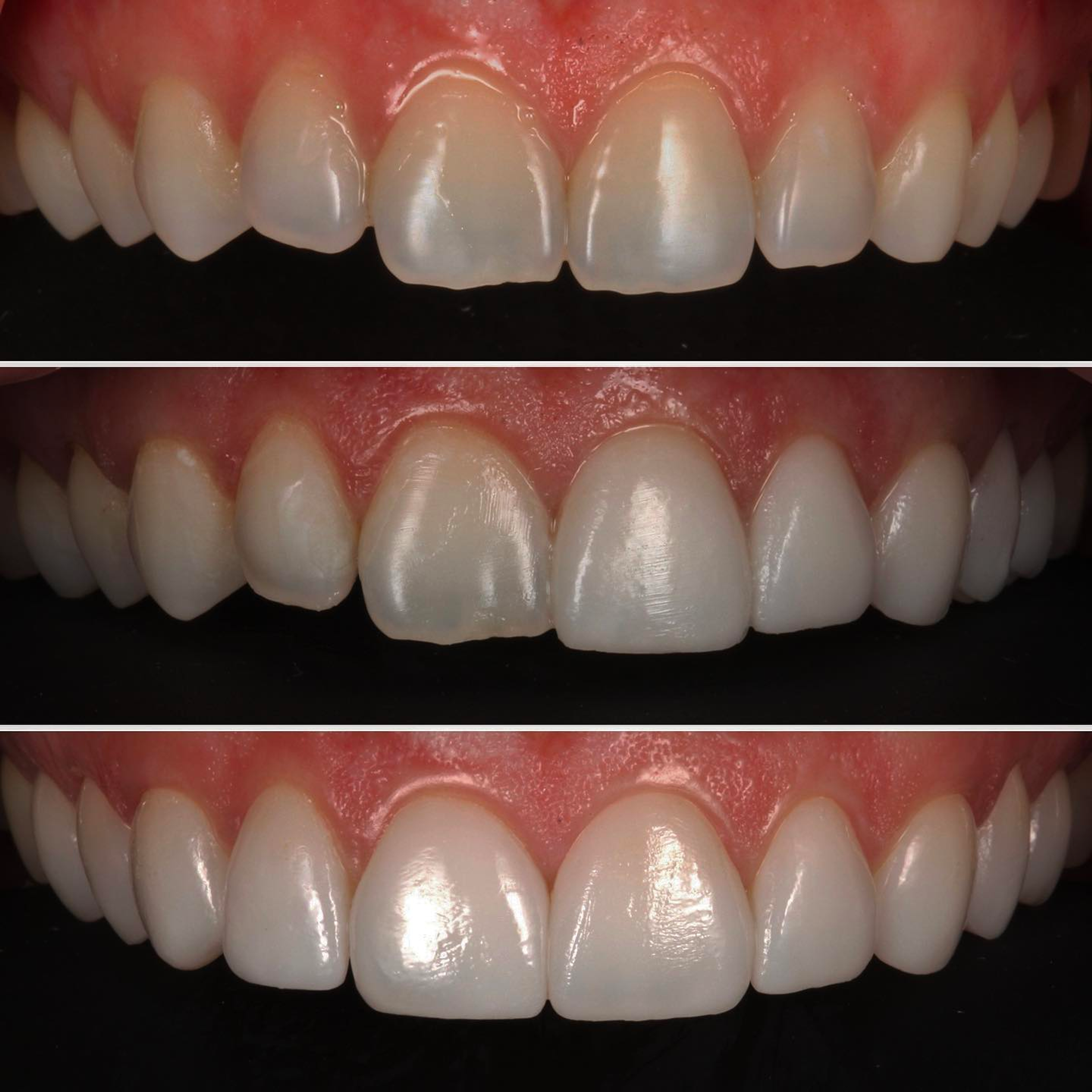 No-prep veneers treatment sequence — before, try-in, and final result