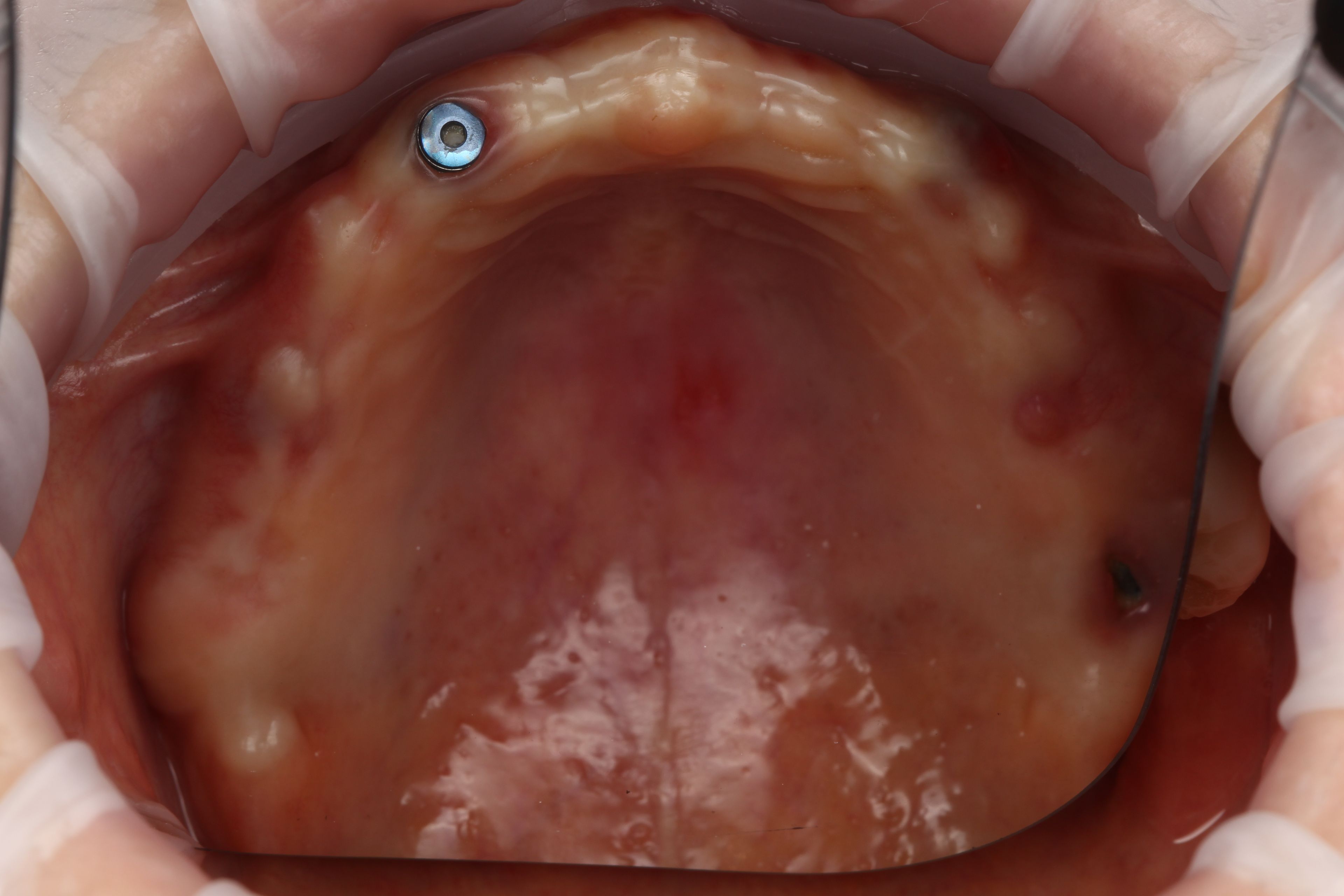 Upper arch after full-arch implant treatment abroad — an implant sits exposed in a poor position on inflamed tissue, uncovered when it should not have been