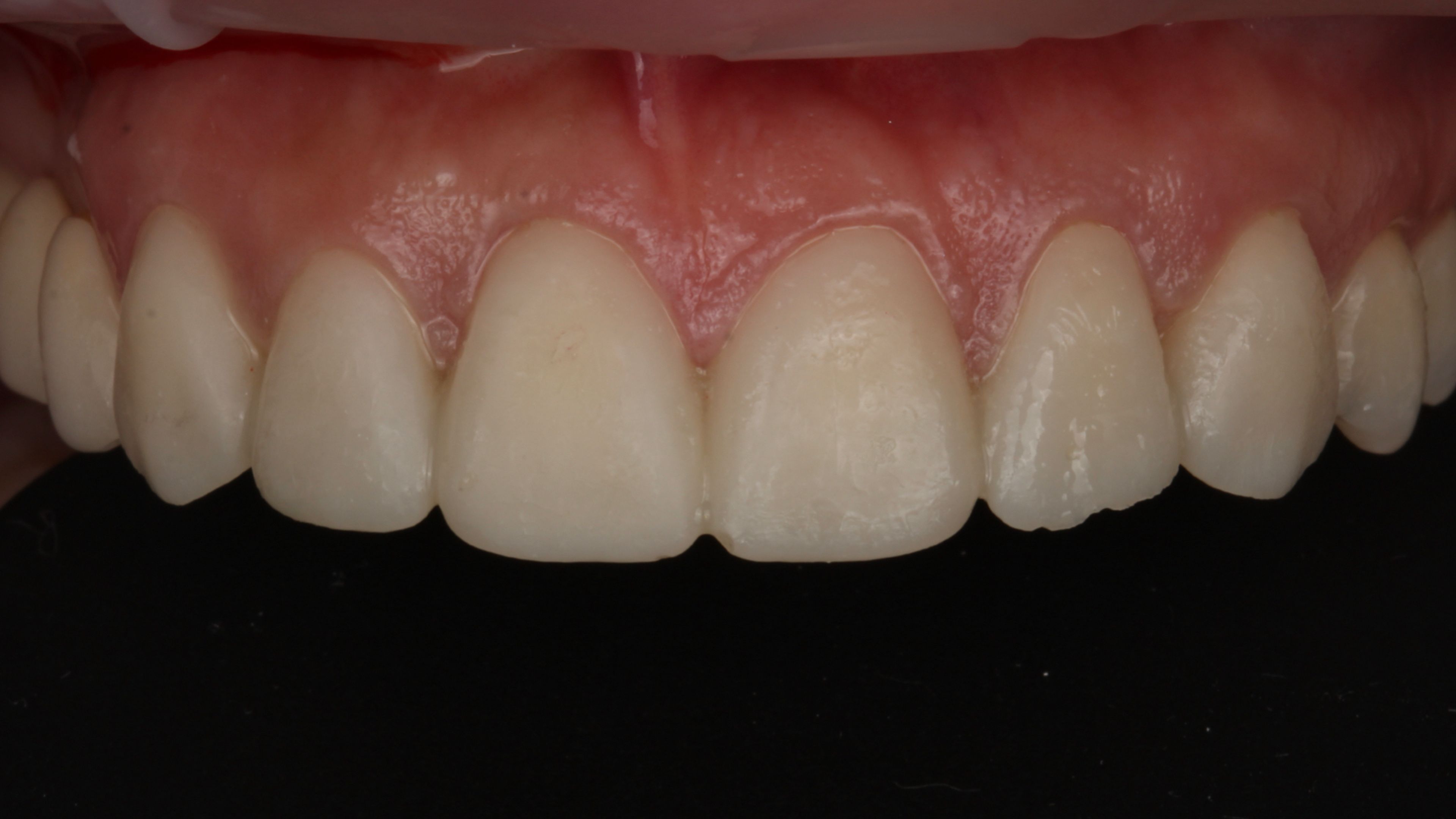 Provisional temporaries placed after minimal preparation — the test-drive phase before final porcelain is fabricated