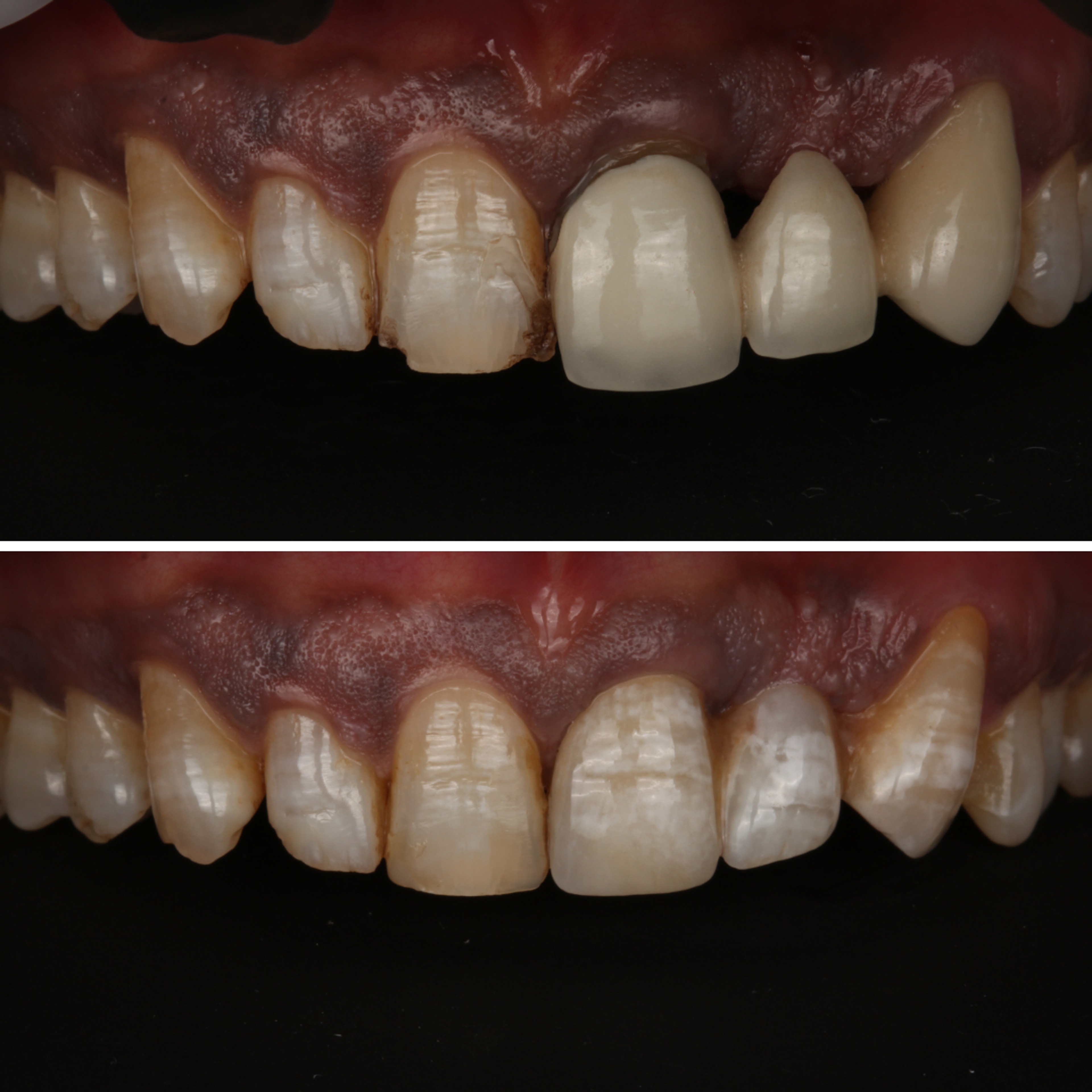 Dental bridge replacing missing teeth — before and after