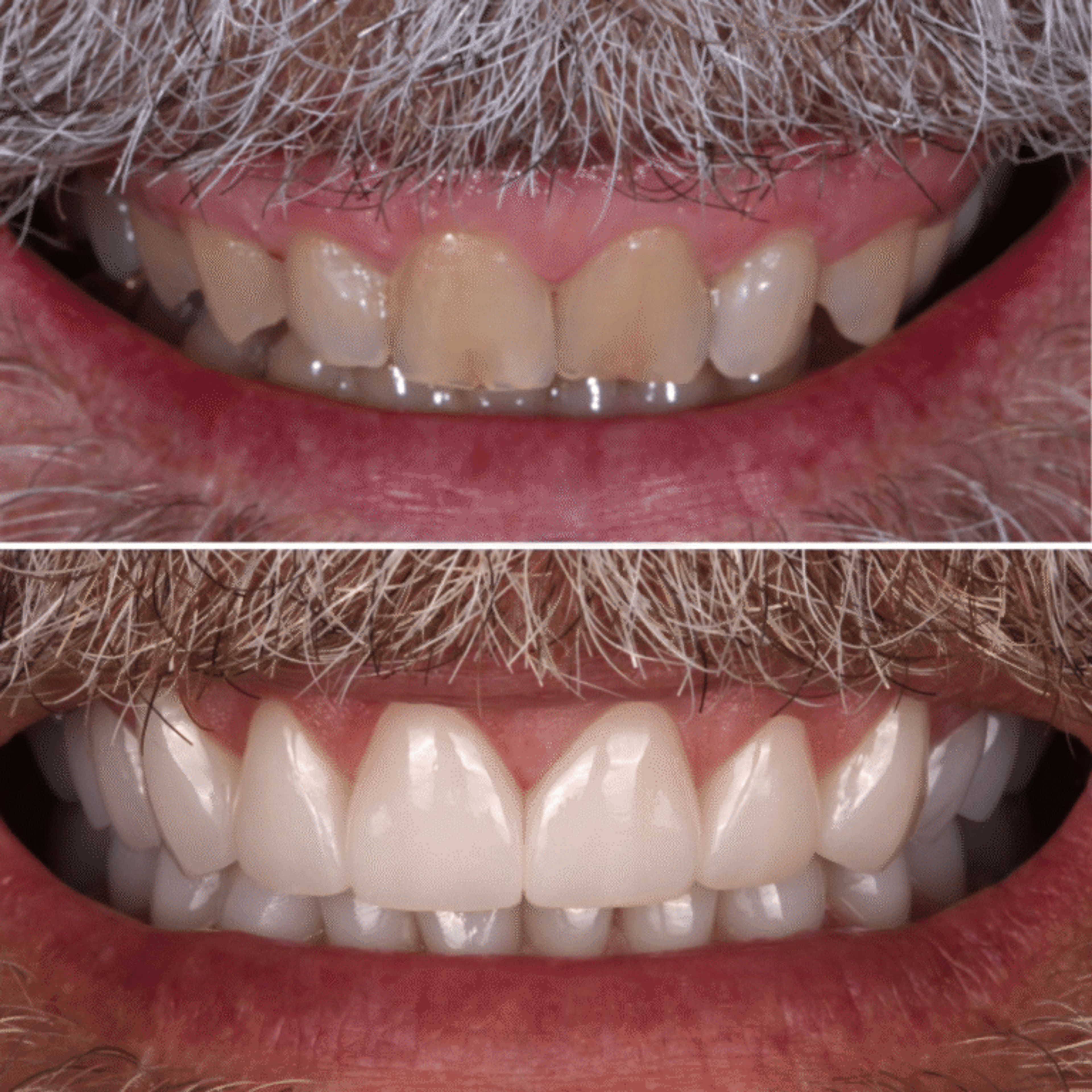 Gummy smile correction — before and after