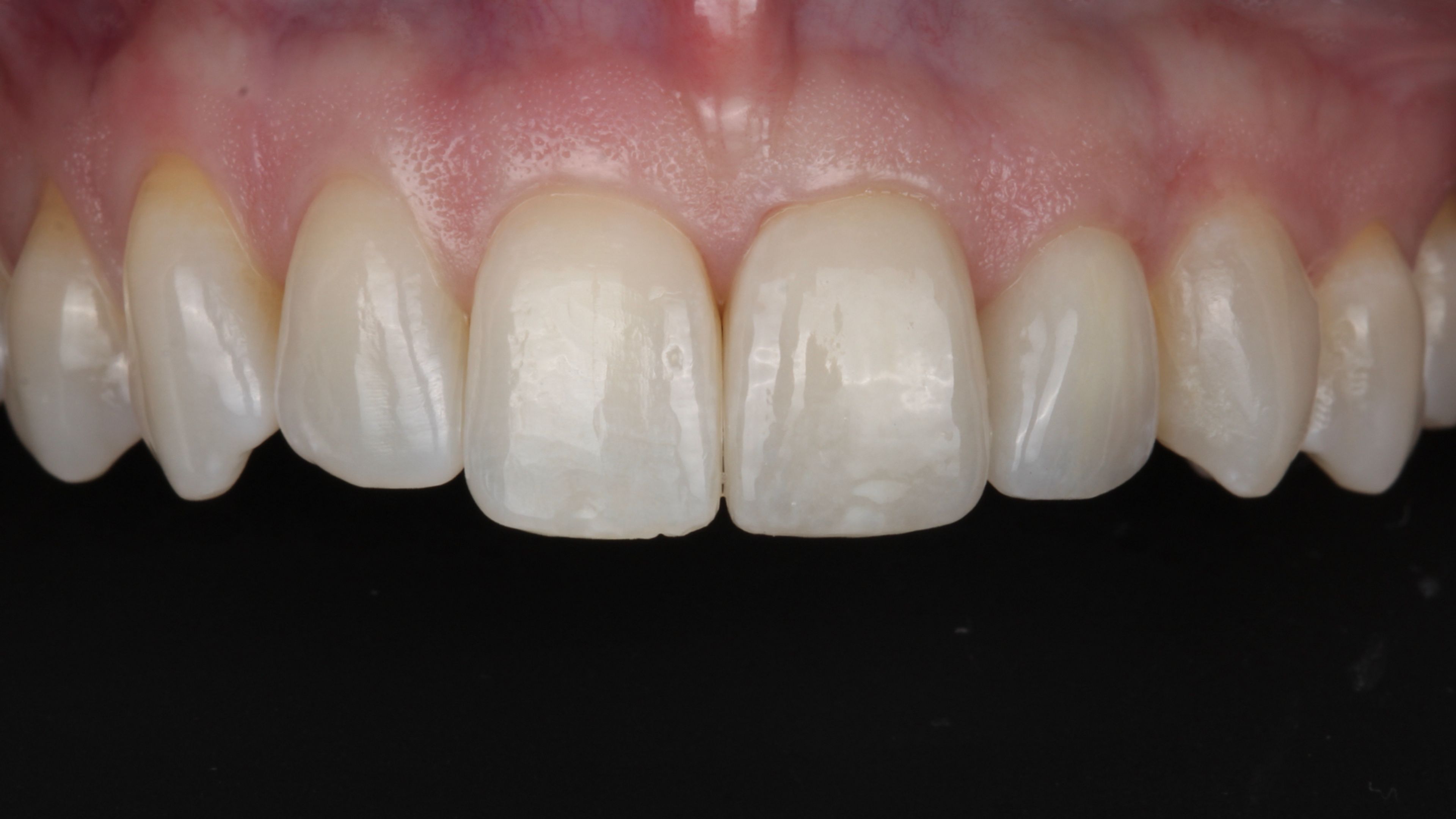 The final porcelain restorations bonded — seamless margins and natural blending with the surrounding teeth