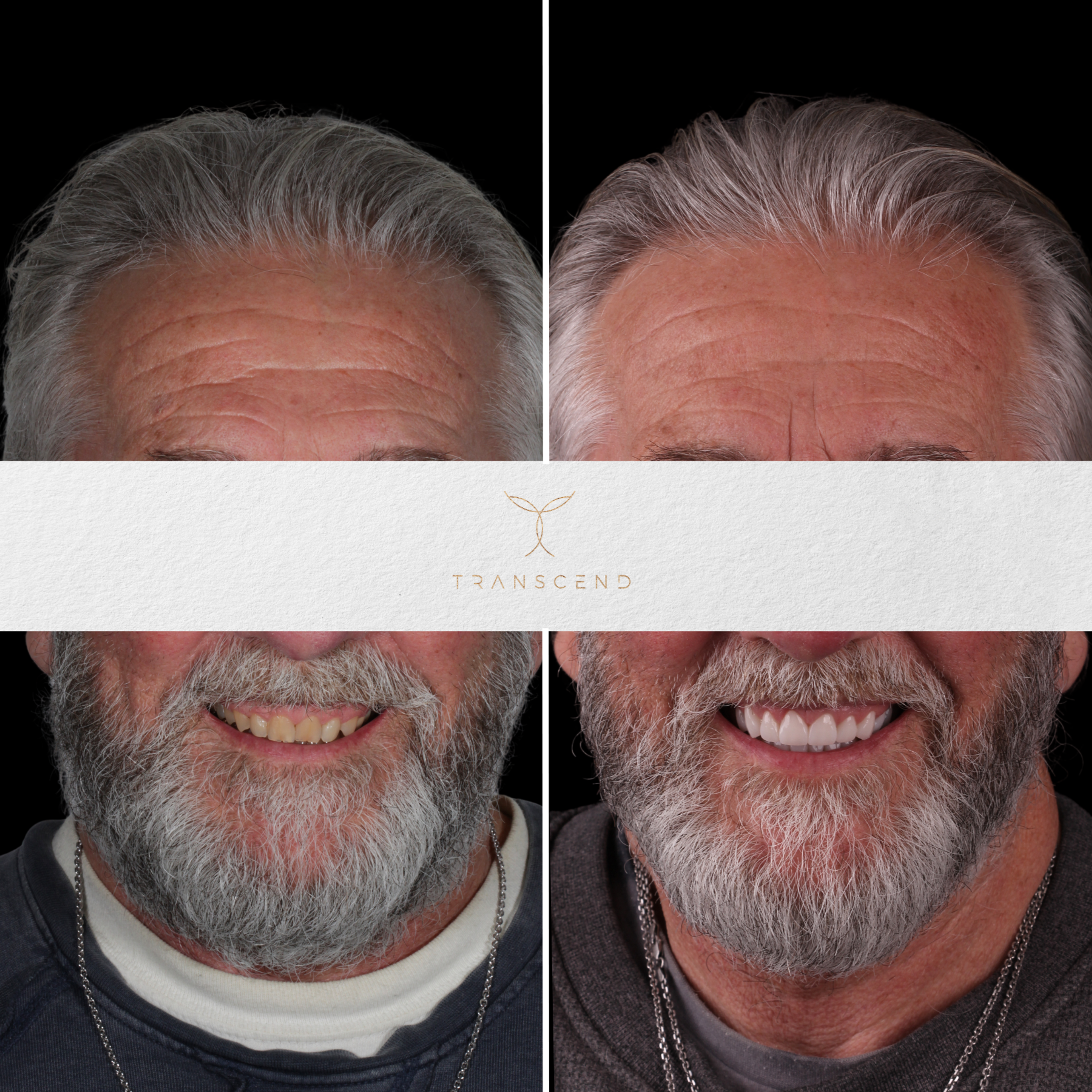 Smile Transformation 9