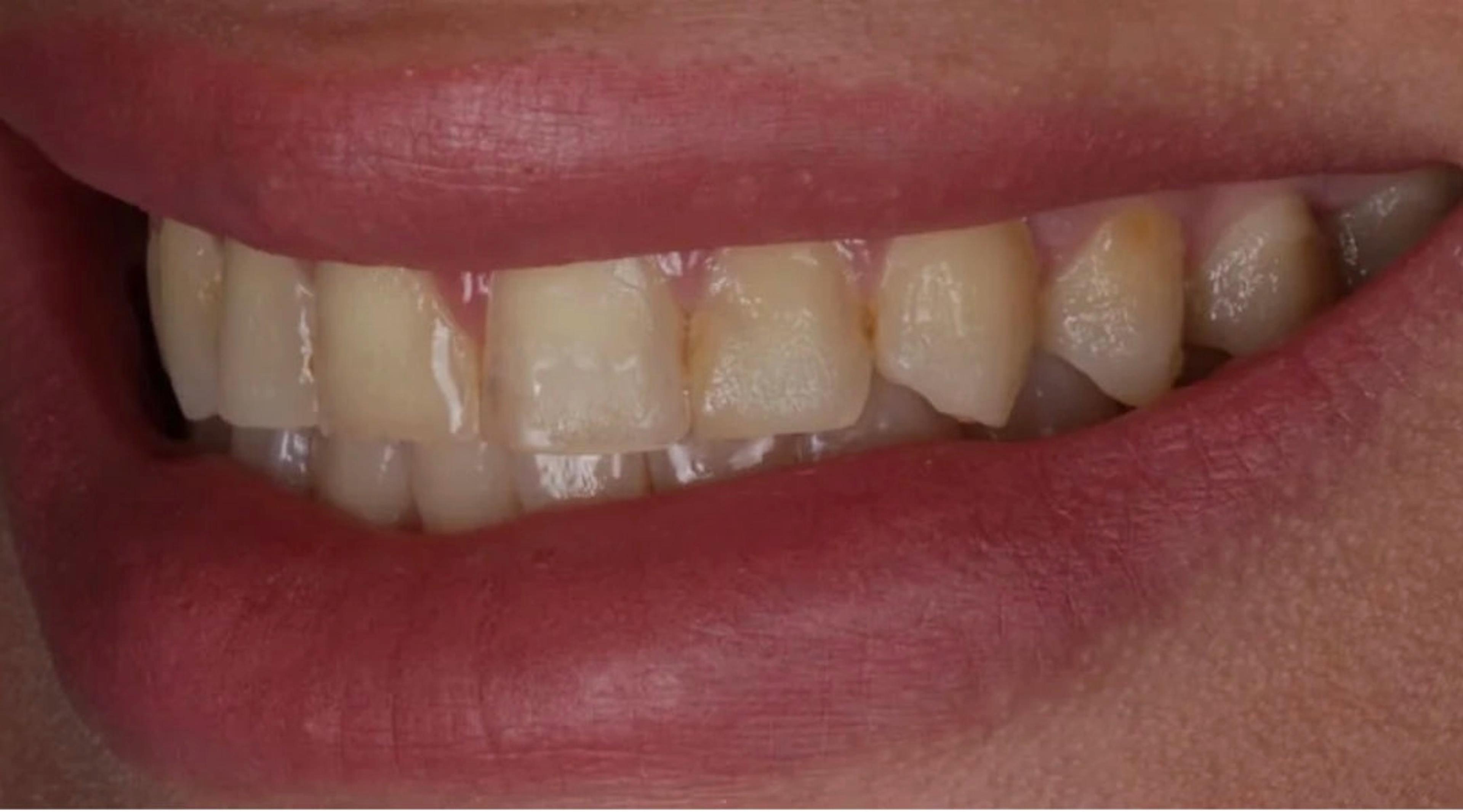 Close-up of a mouth with discolored unhealthy teeth, "before" picture of smile makeover.