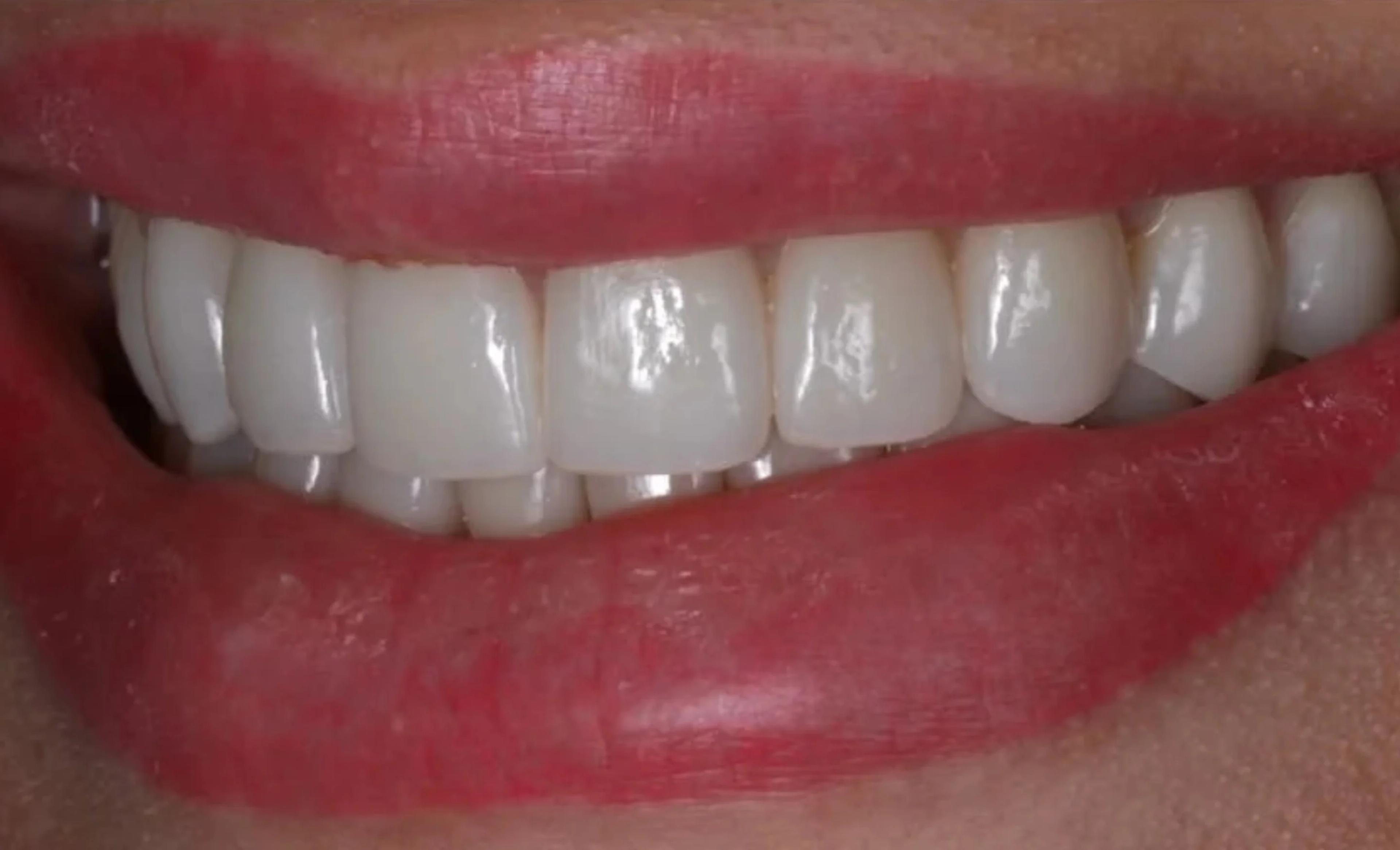 Close-up of a mouth with beautiful pearly white teeth, "after" picture of smile makeover.