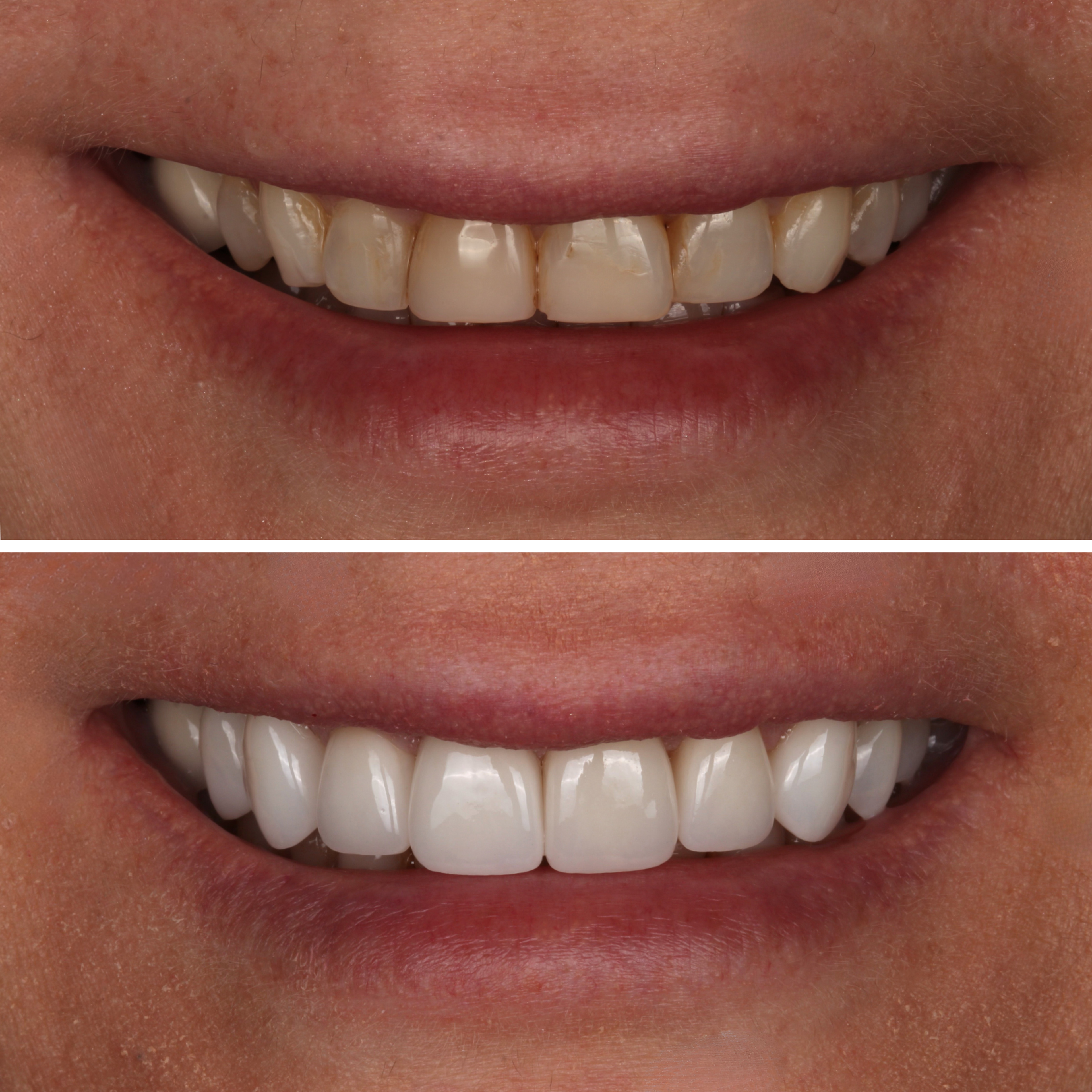 8 Porcelain Veneers before and after - porcelain veneers Vancouver - Transcend Dentistry