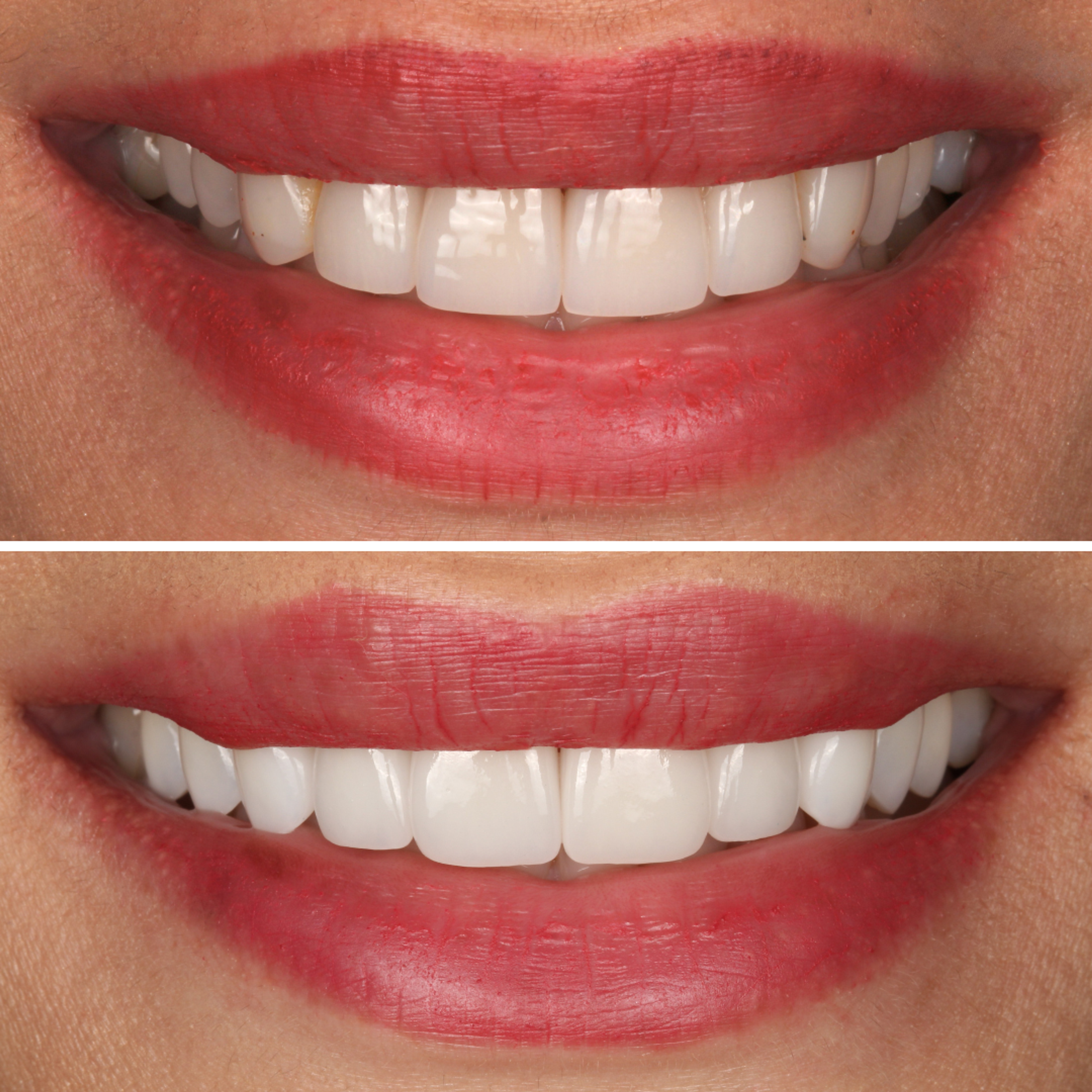 Porcelain Veneers — before and after