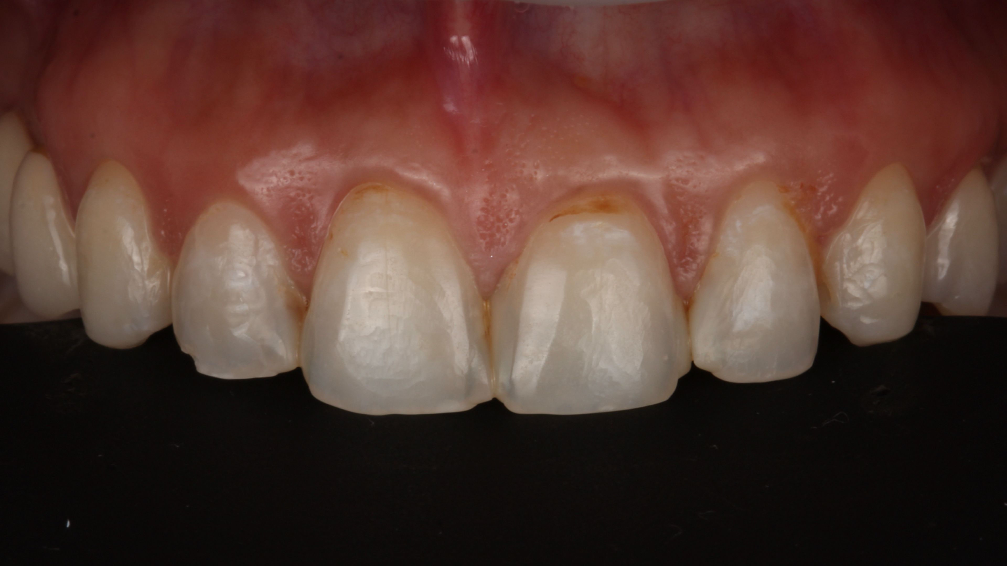 Front teeth before treatment in a minimal-prep porcelain veneer case