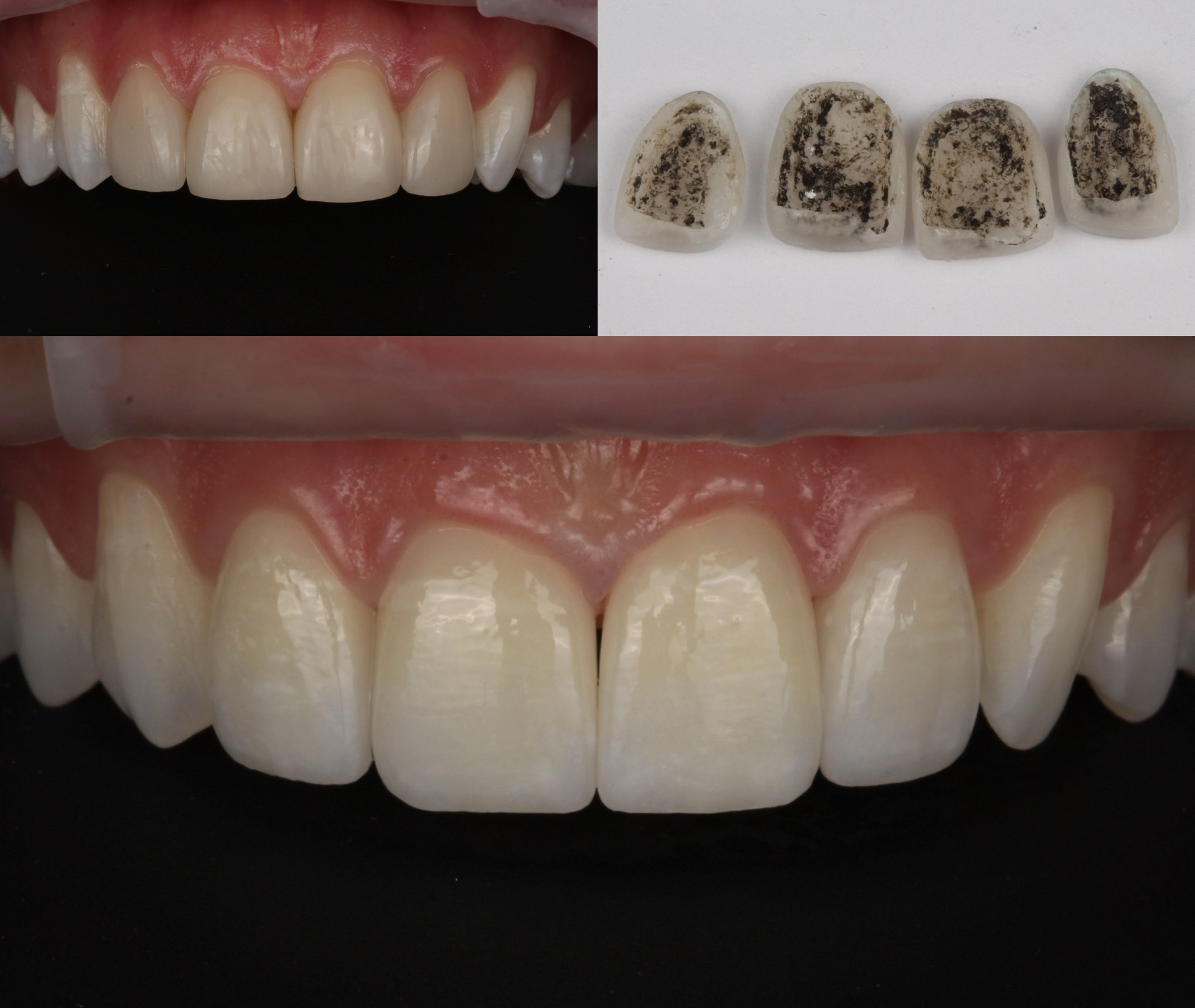 A redo case at Transcend Specialized Dentistry — the original veneers the patient was unhappy with and the same veneers after atraumatic laser removal shown together, with the new natural-looking porcelain veneers below