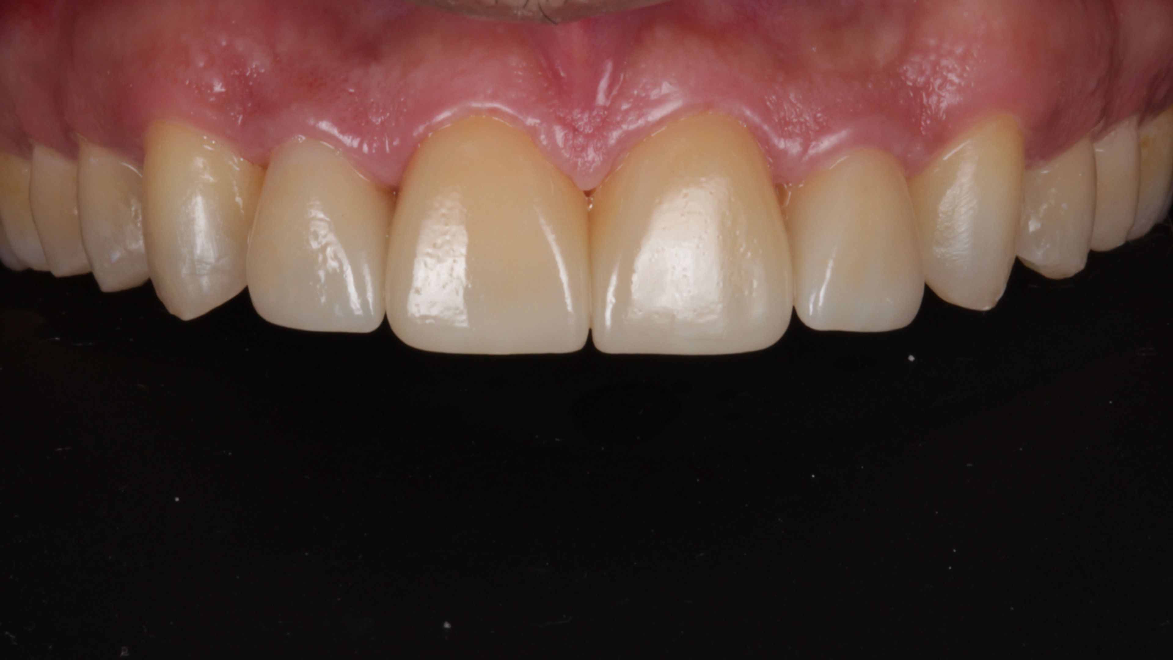 The same patient after the twenty veneers were removed atraumatically with an erbium laser and only the front four were replaced — the rest of the teeth are now the patient's own natural enamel
