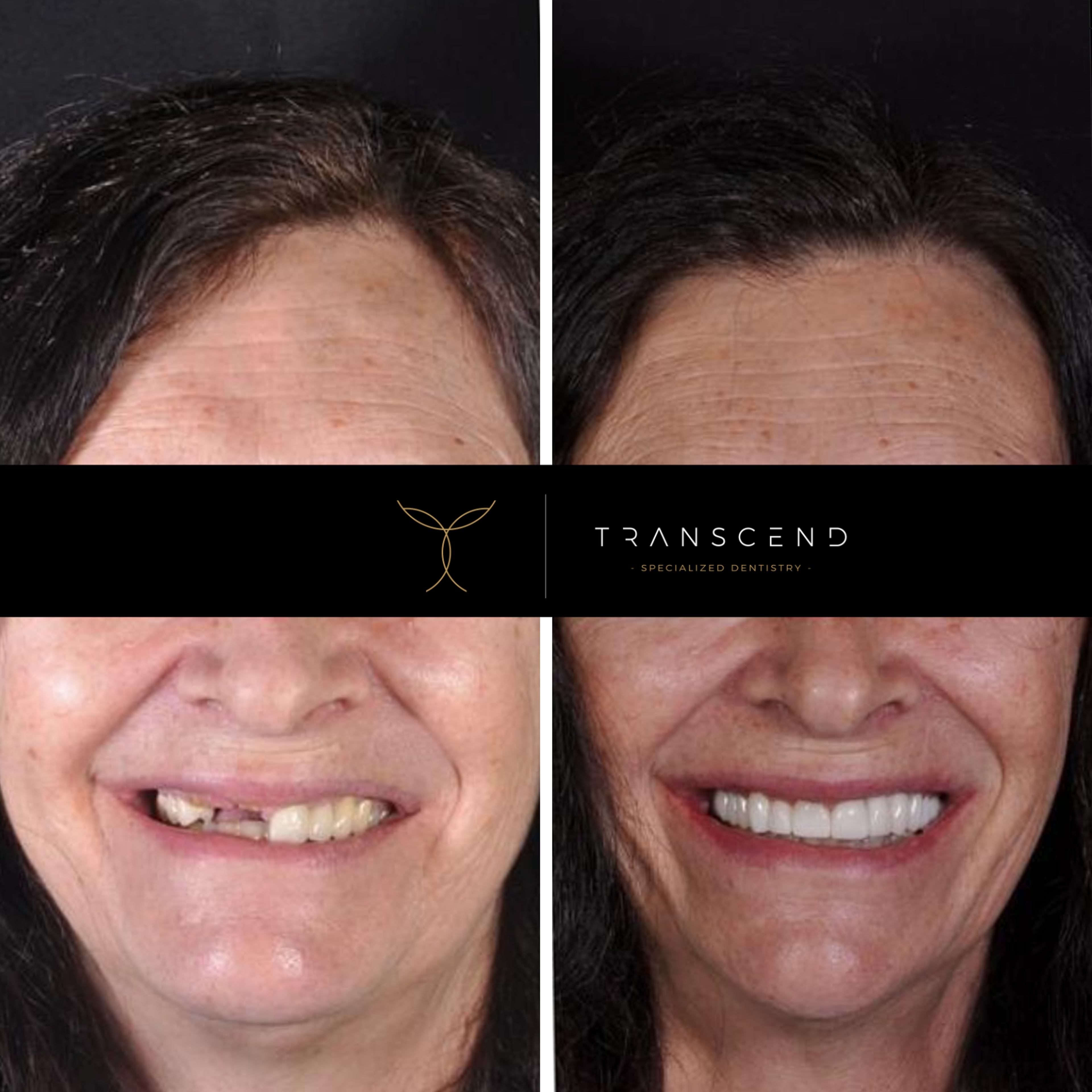 Before and after portraits of a female patient who had dental implants made and placed.