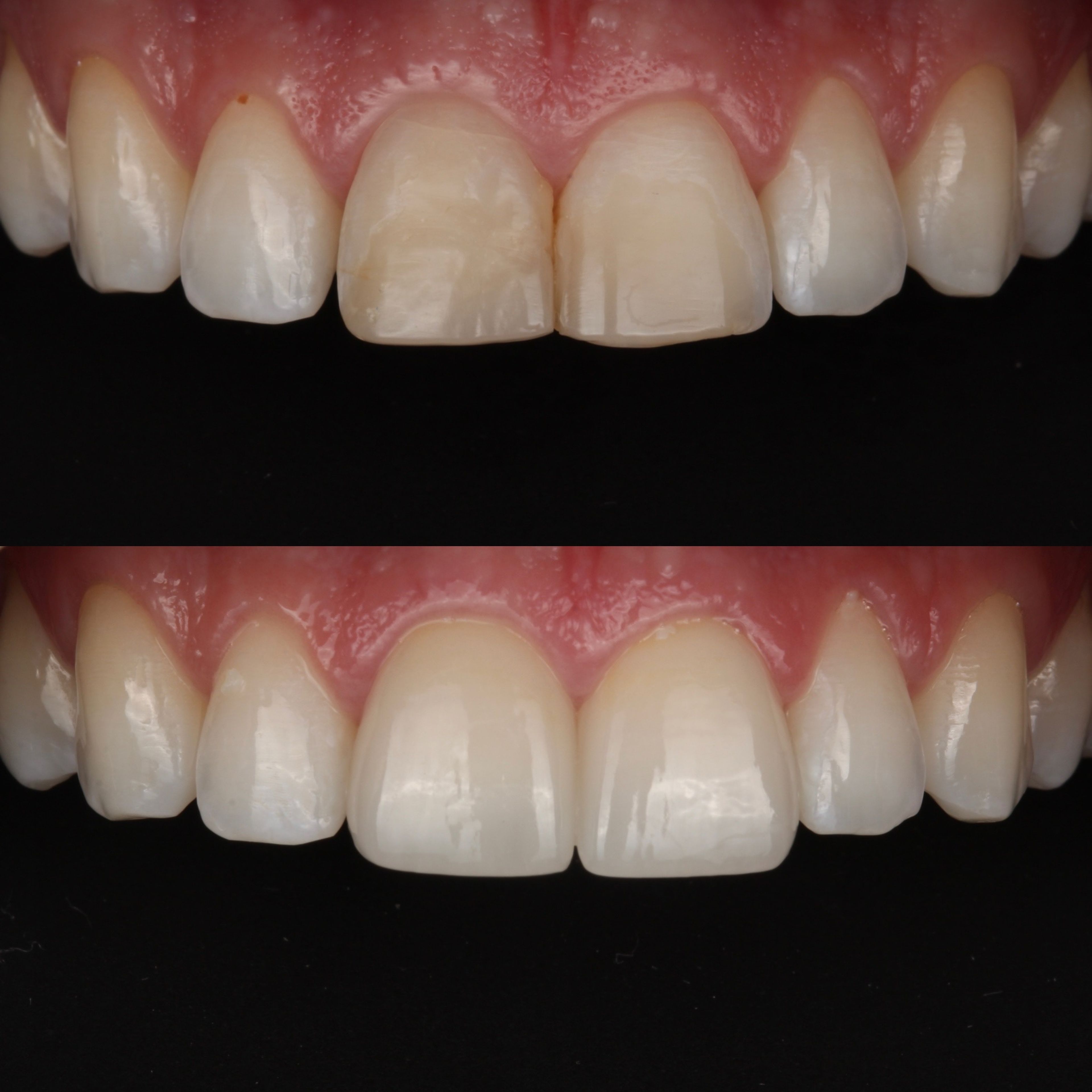 Porcelain Crowns — Central Incisors before and after - cosmetic dentistry Vancouver - Transcend Dentistry