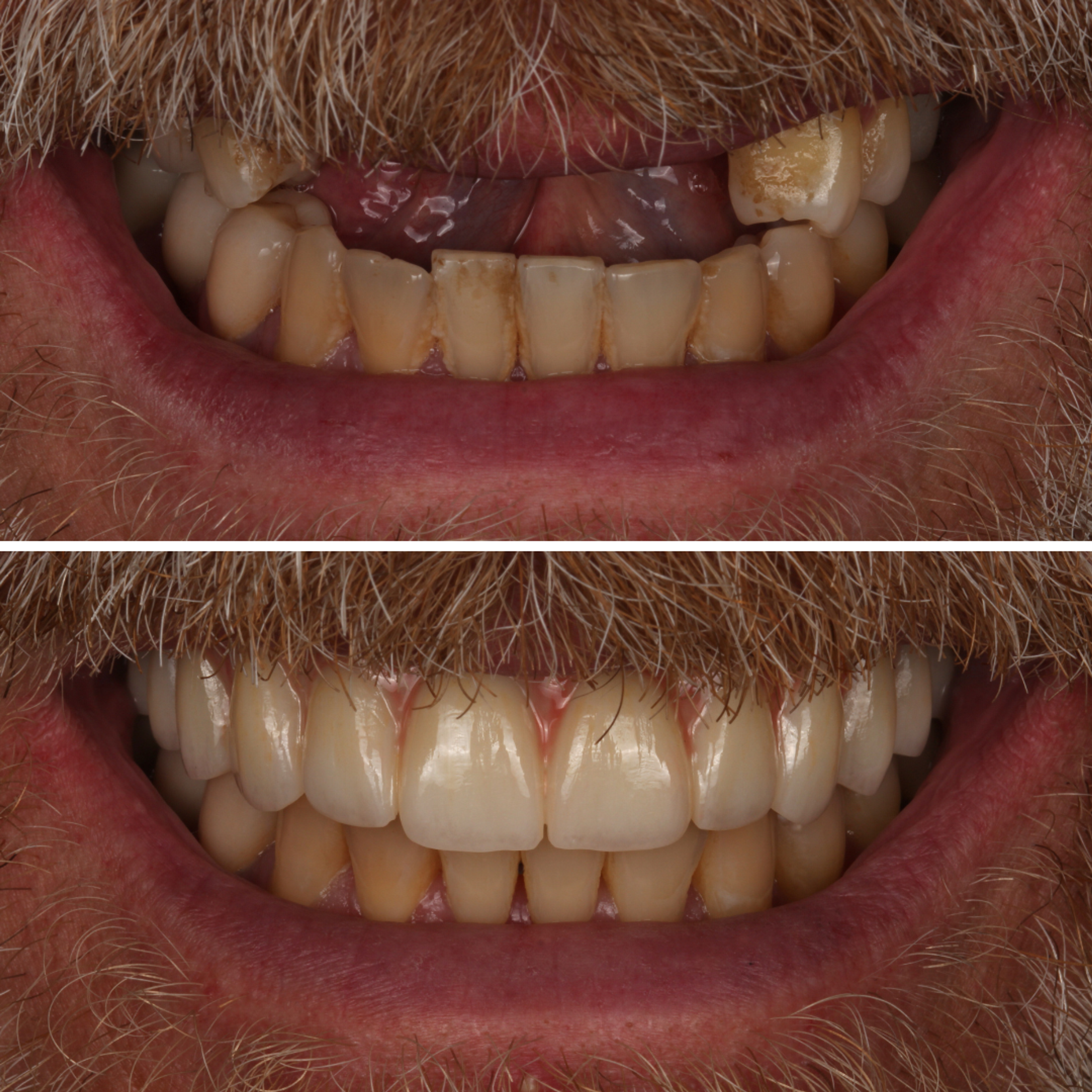Upper All-on-4 before and after - All-on-4 implants Vancouver - Transcend Dentistry