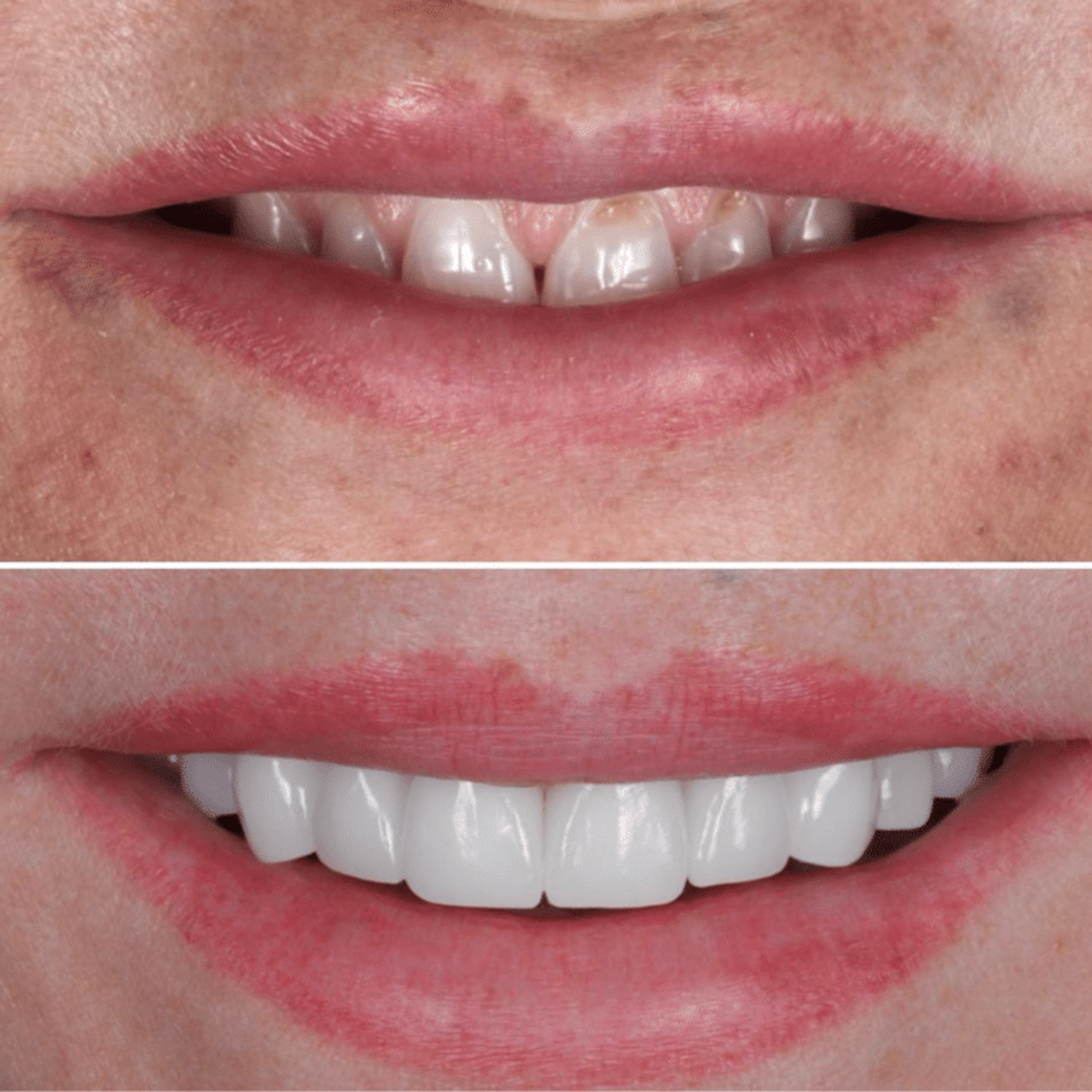Full Mouth Reconstruction — before and after