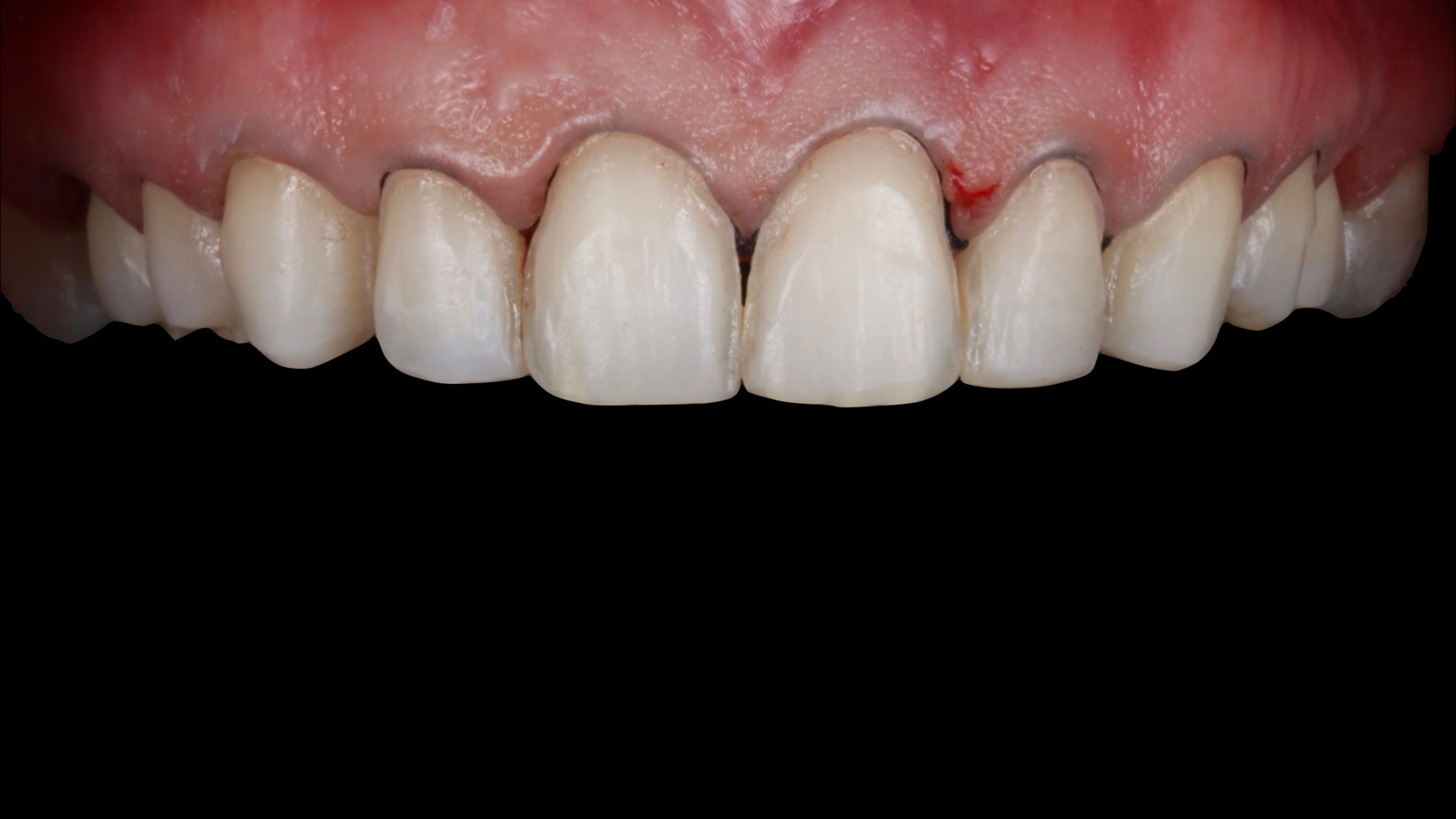 After gentle enamel-only preparation — the prep stayed entirely within enamel for a durable long-term bond