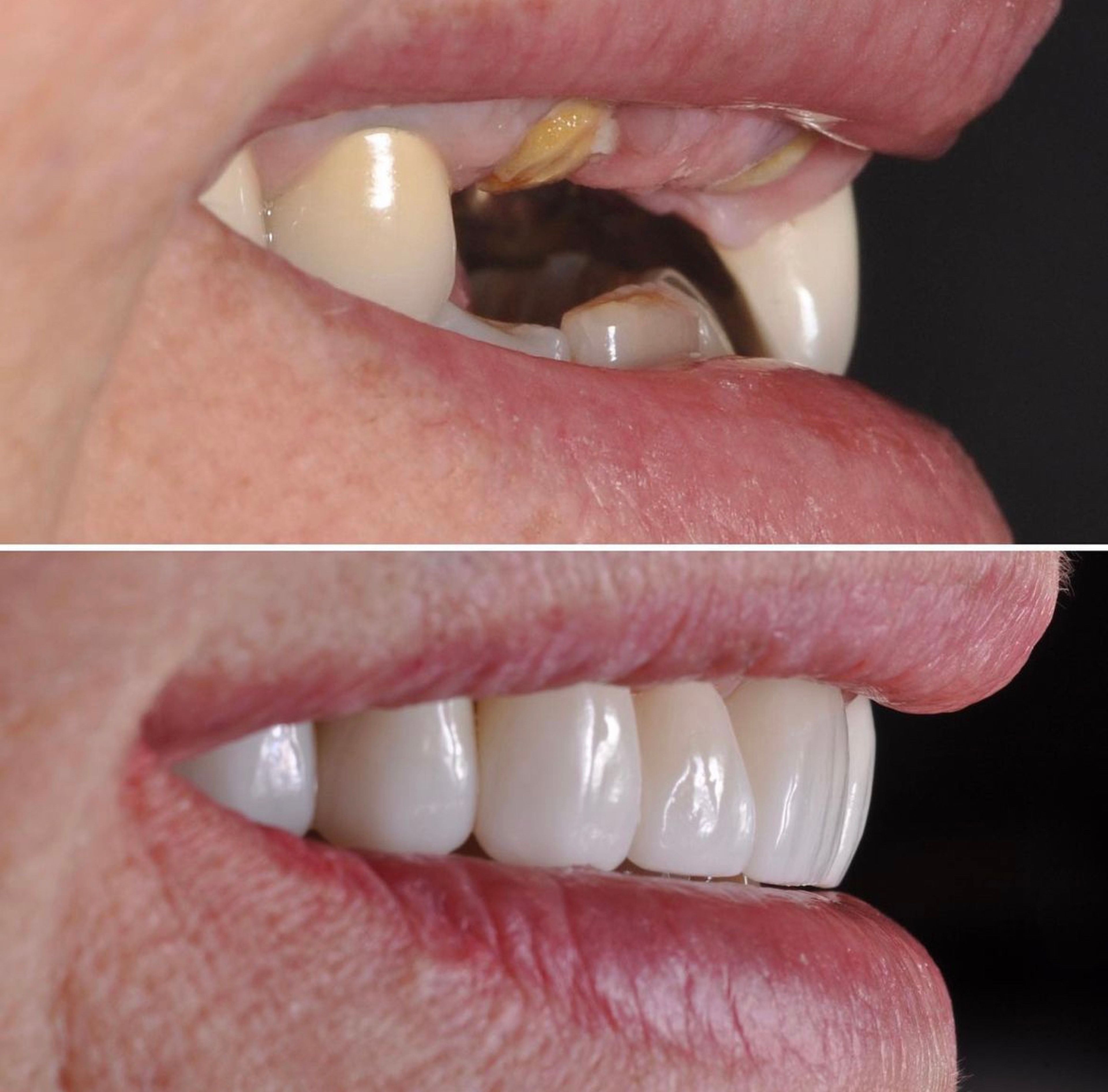Anterior Implant before and after - dental implants Vancouver - Transcend Dentistry