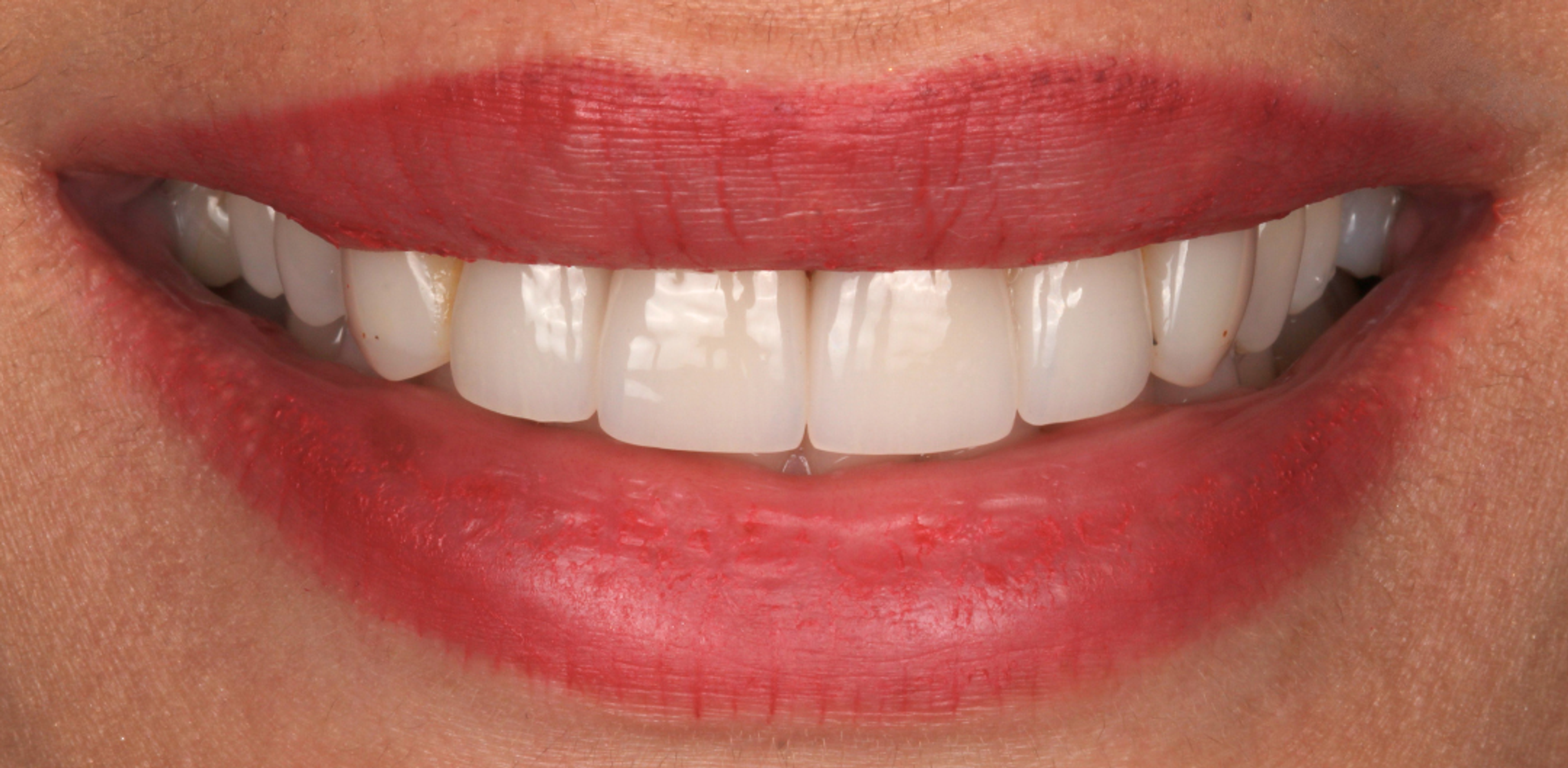 A smile before treatment at Transcend — uneven, discoloured upper teeth framed by bright red lips