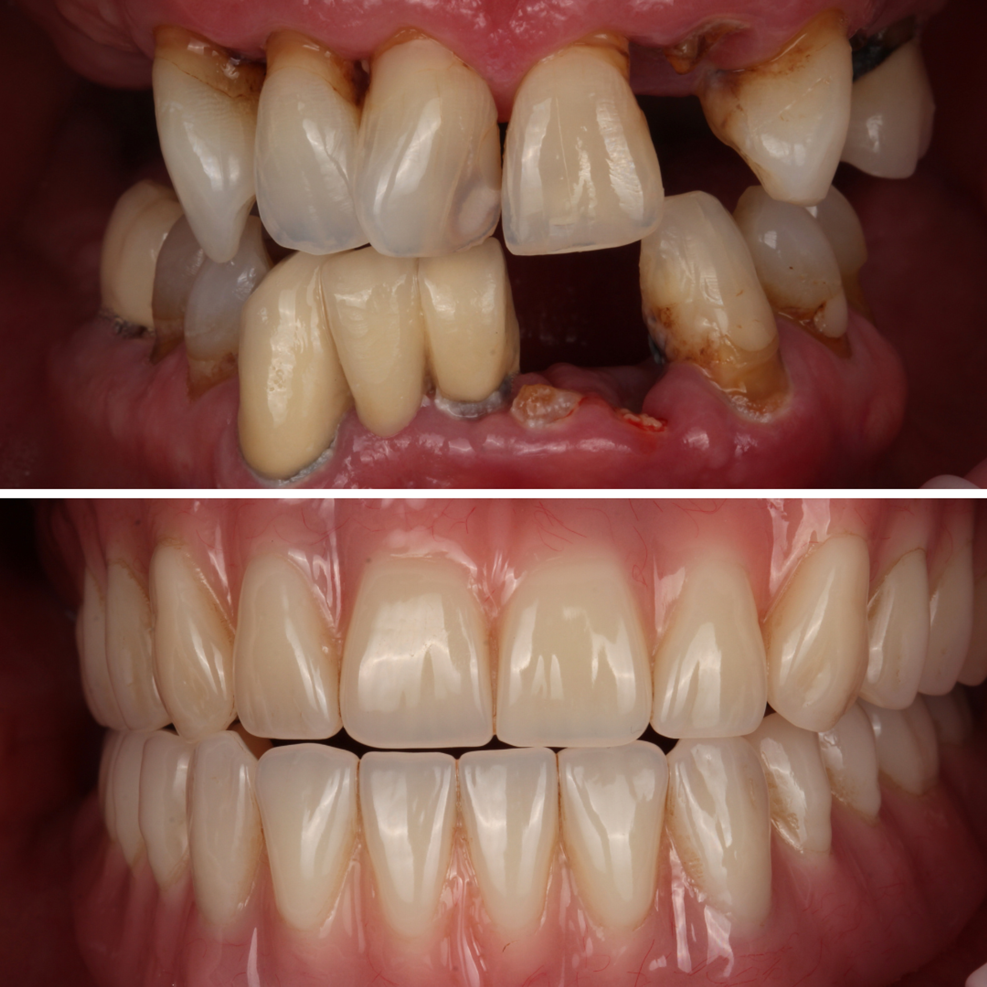 Implant Overdentures — Clinical — before and after