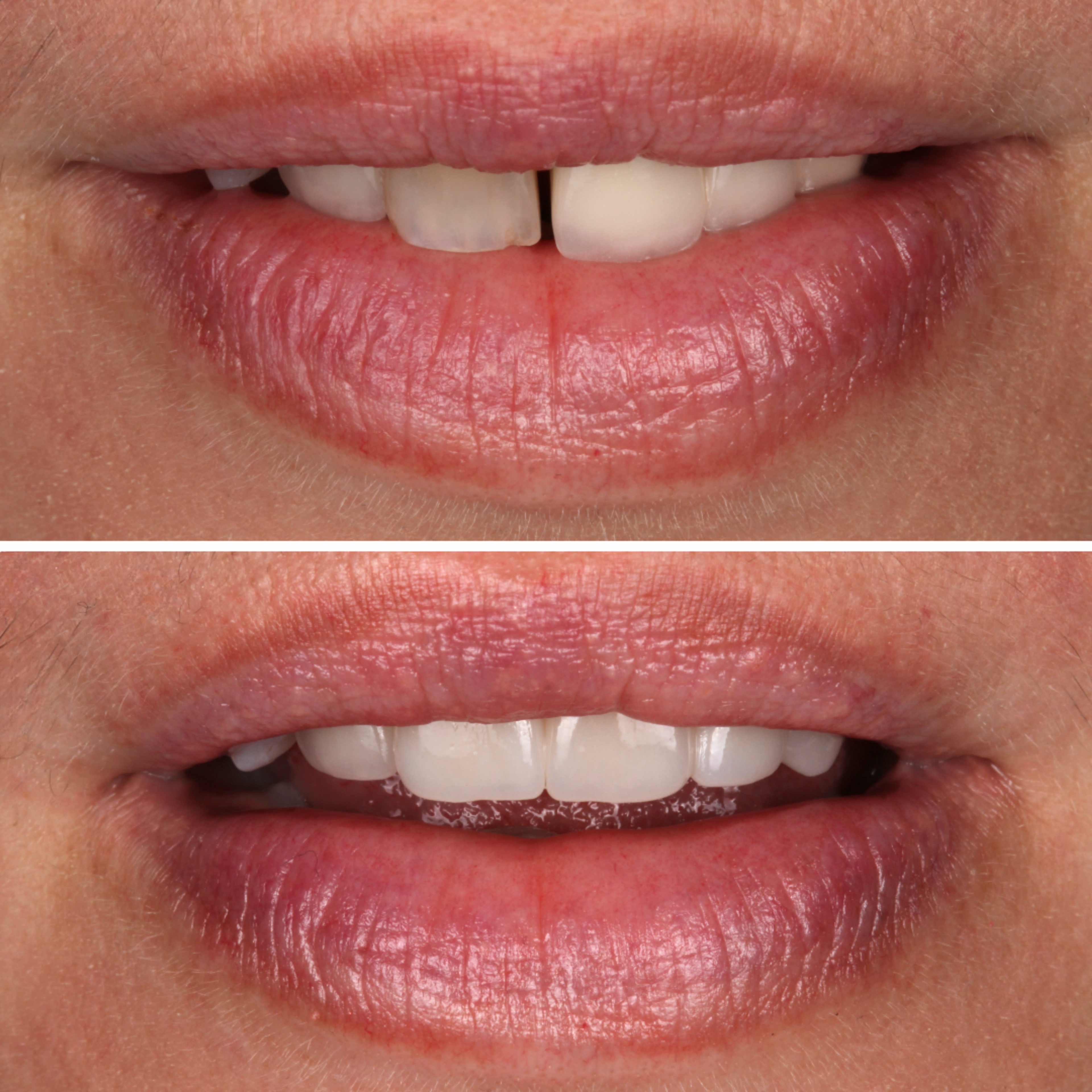 Crown and Bridge — before and after