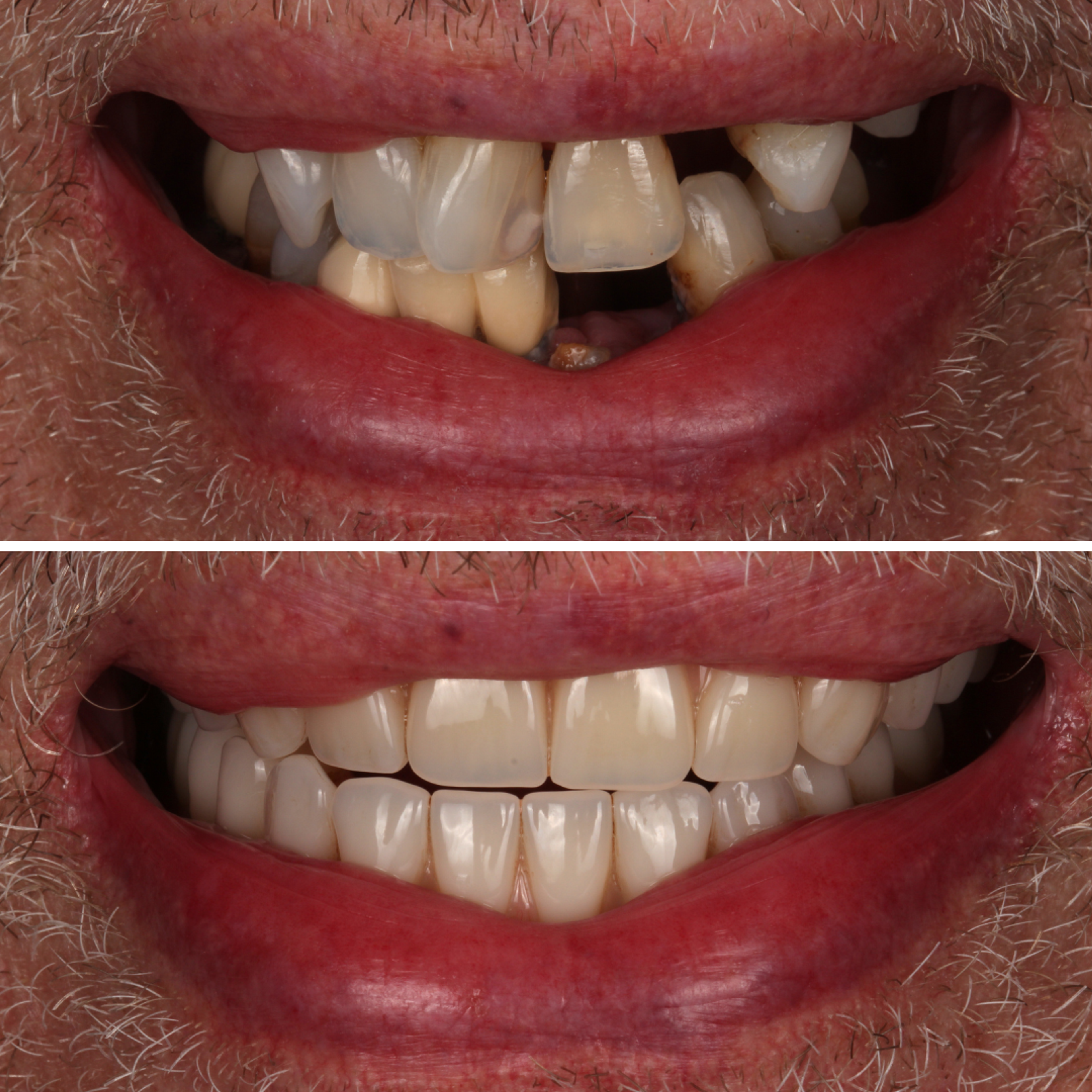 Implant Overdentures before and after - All-on-4 implants Vancouver - Transcend Dentistry