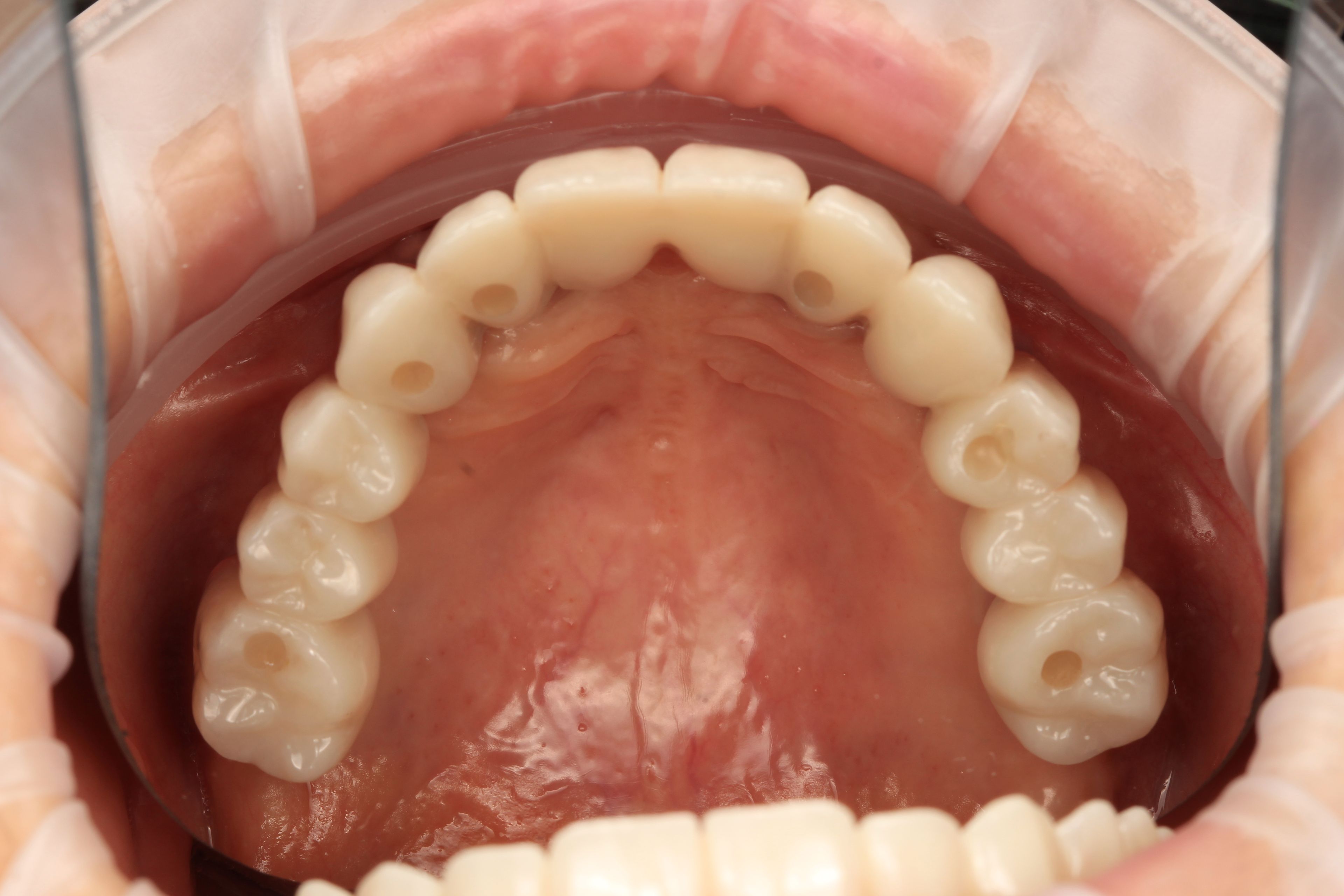 The same arch after the redo — new implants placed in restorable positions and a new full-arch bridge in place on healthy tissue
