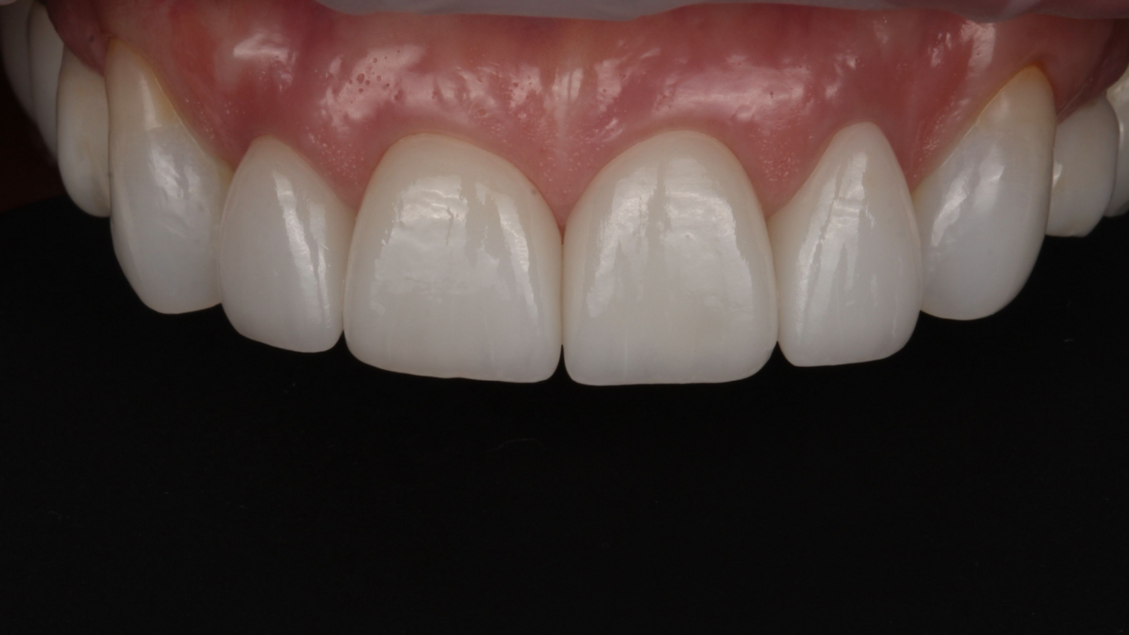 Final result with porcelain veneers bonded — natural proportions and seamless integration with the surrounding teeth