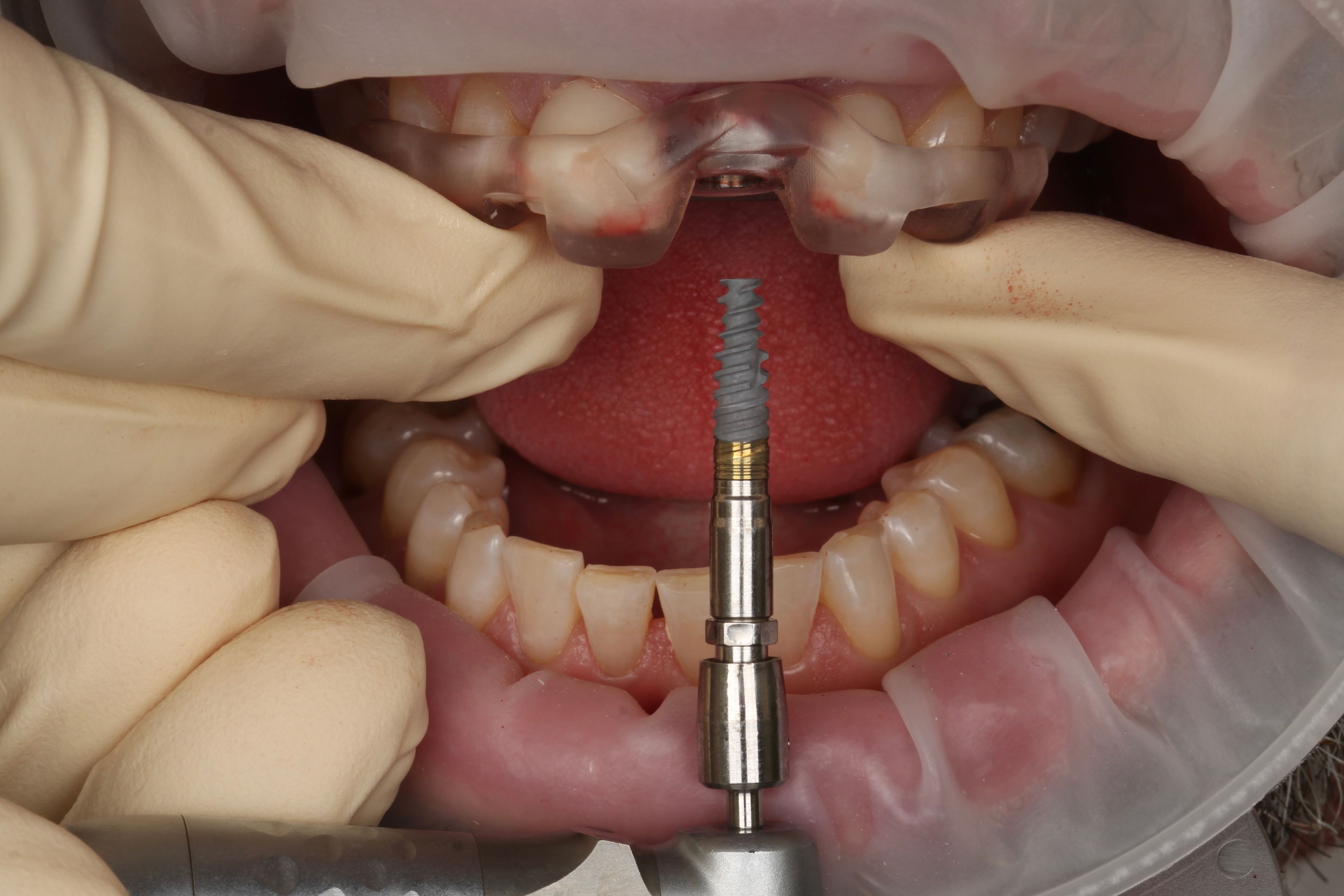 Guided dental implant surgery at Transcend Specialized Dentistry Vancouver