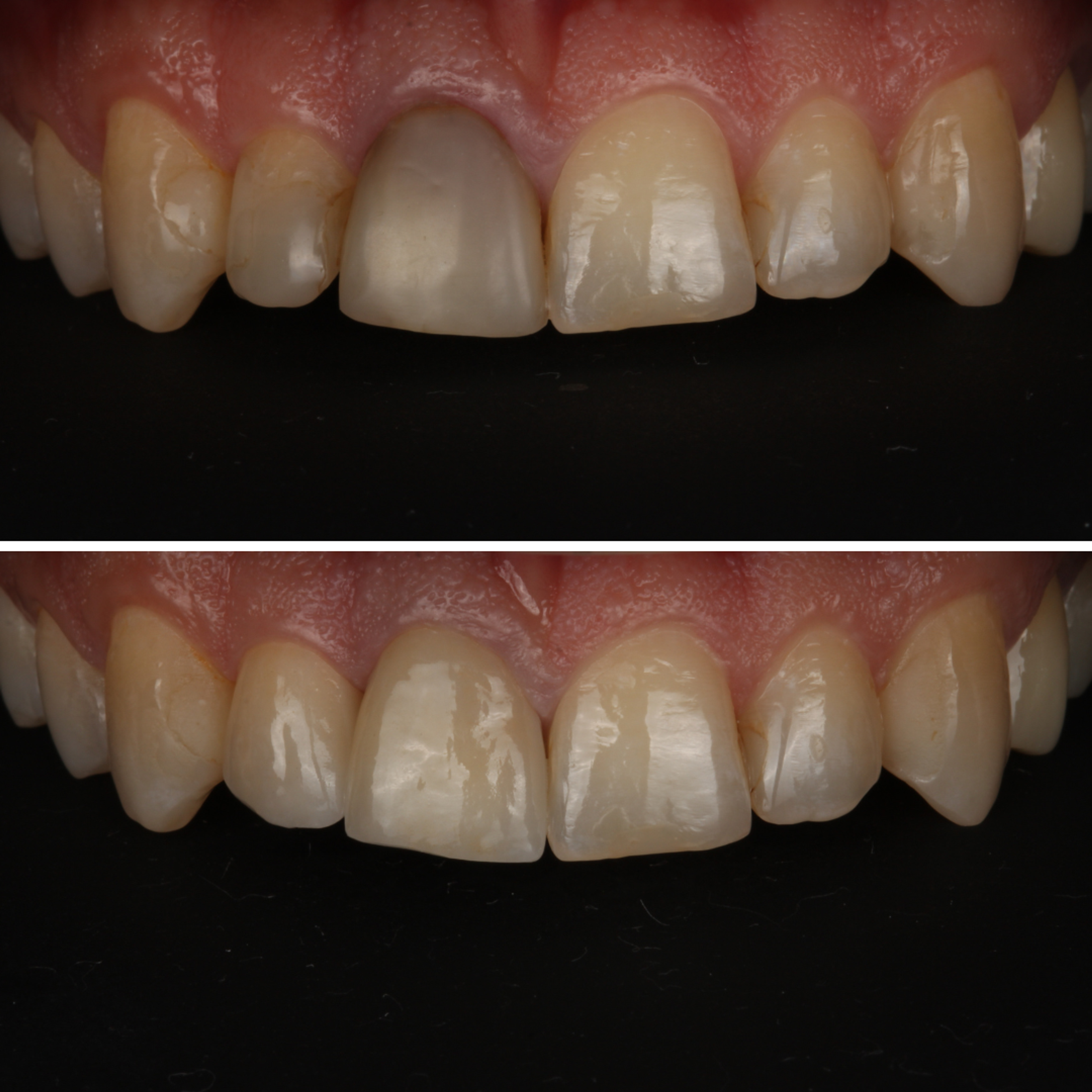 Two Veneers — Central and Lateral — before and after