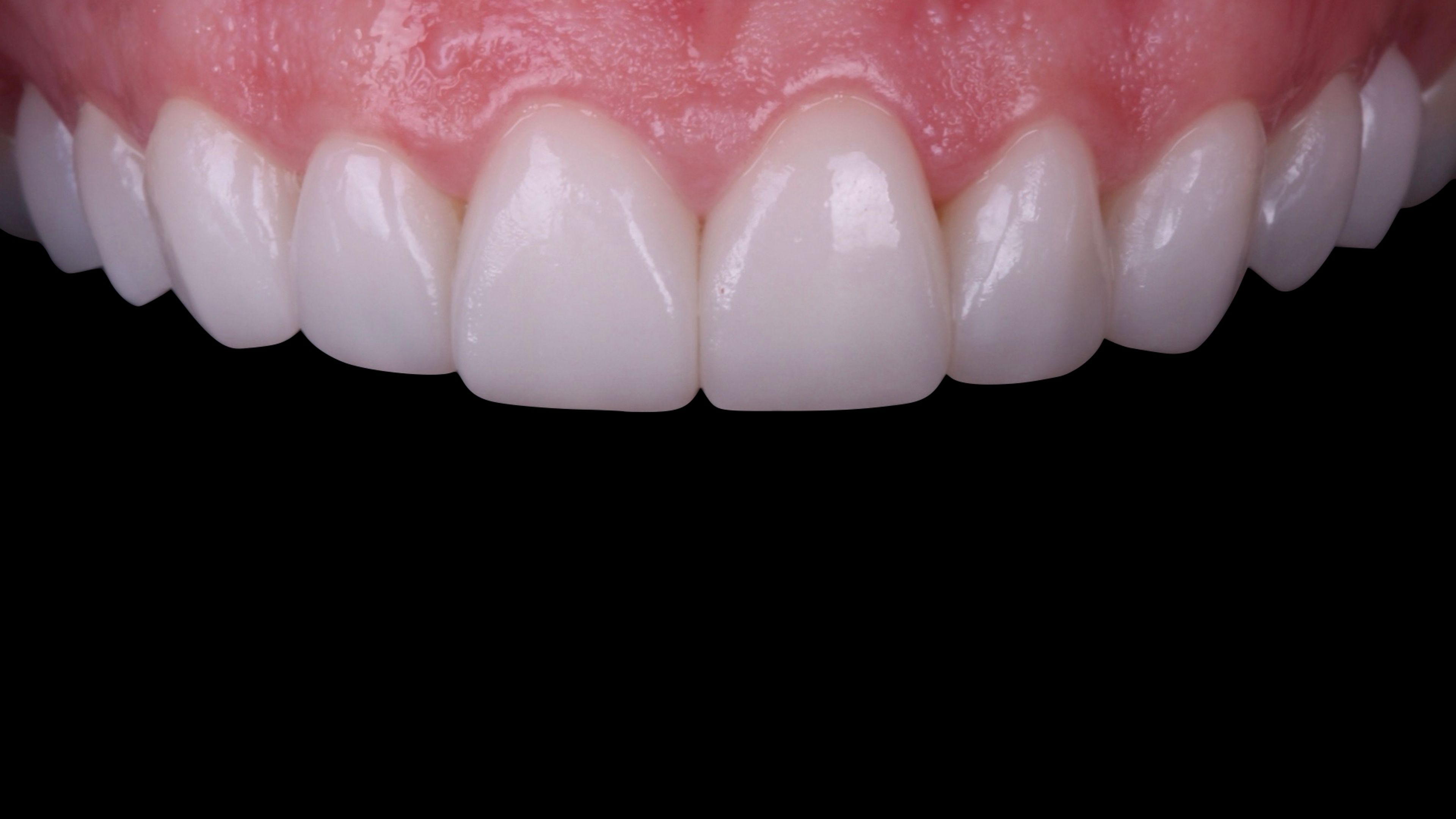 Final result of the minimal-prep porcelain veneer case